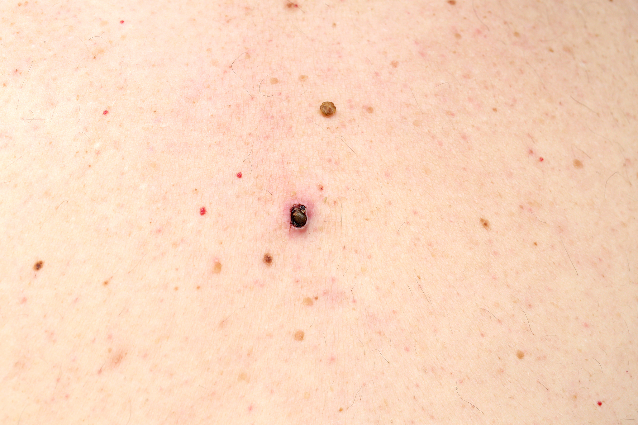 blackhead