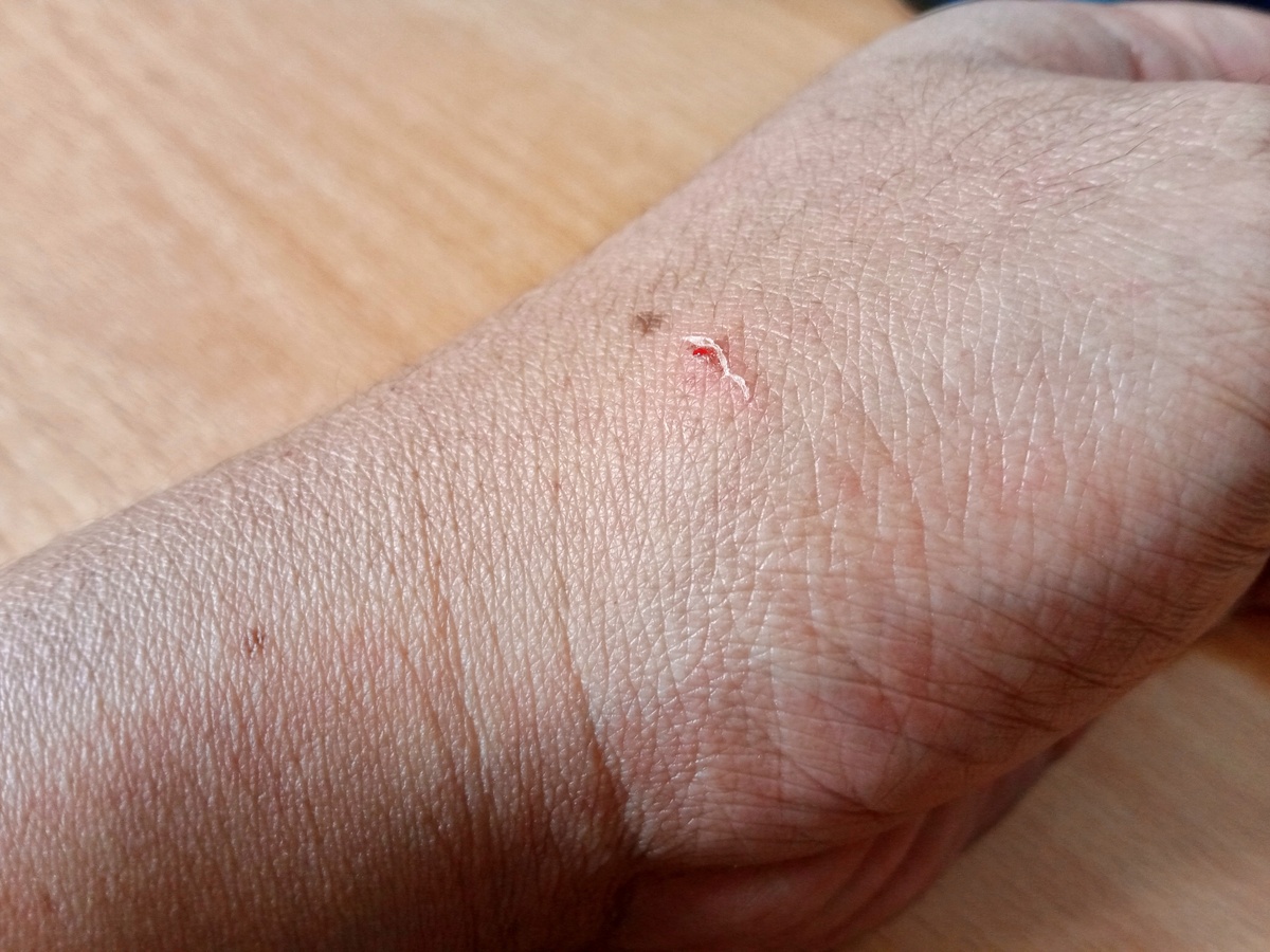 伤口结痂后，什么时候可以拆纱布？