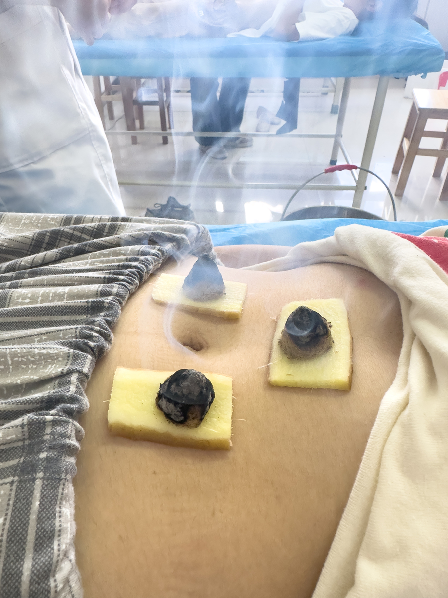 隔物灸治疗腰椎间盘突出有效吗？原理方法及注意事项