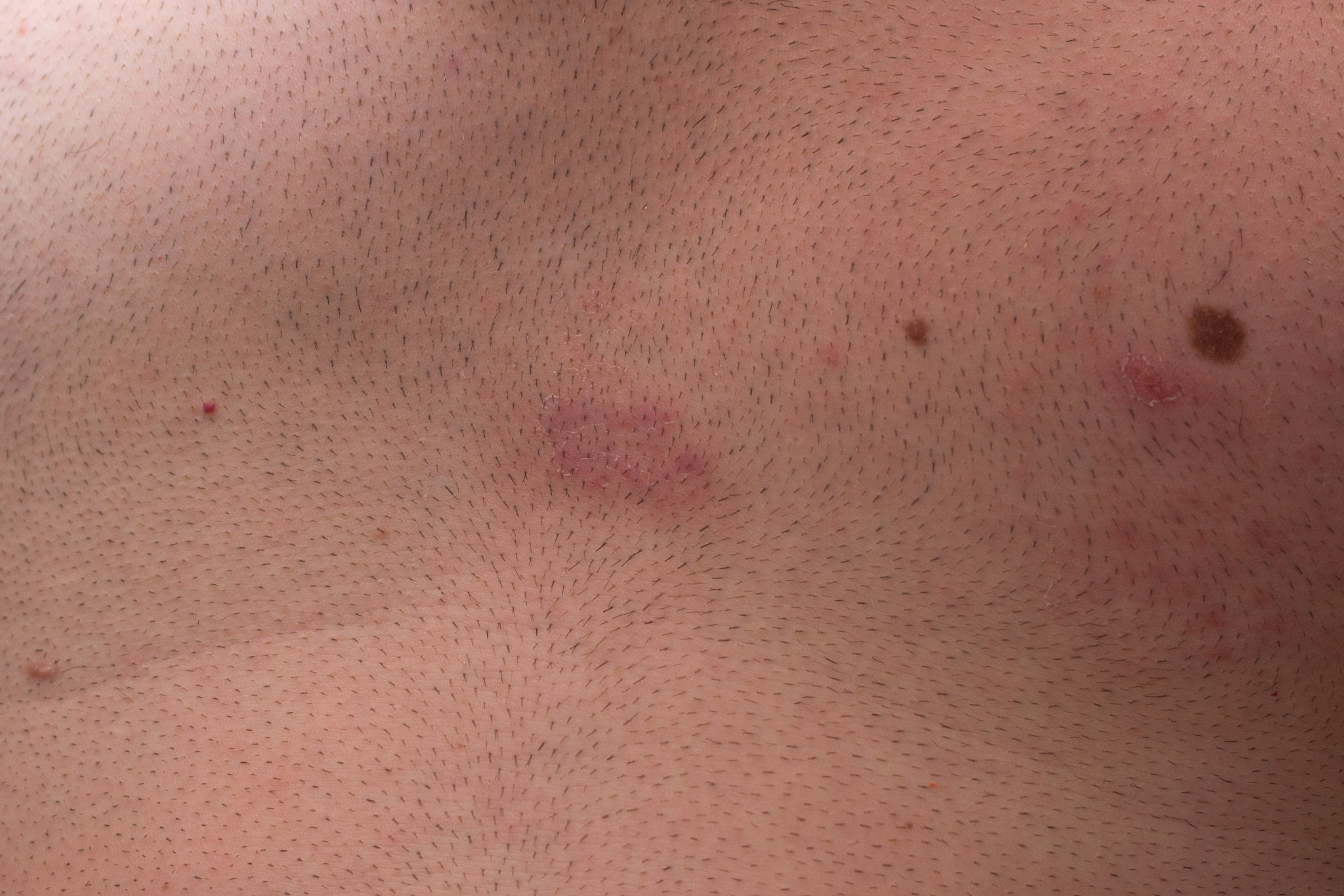 zona zoster infection