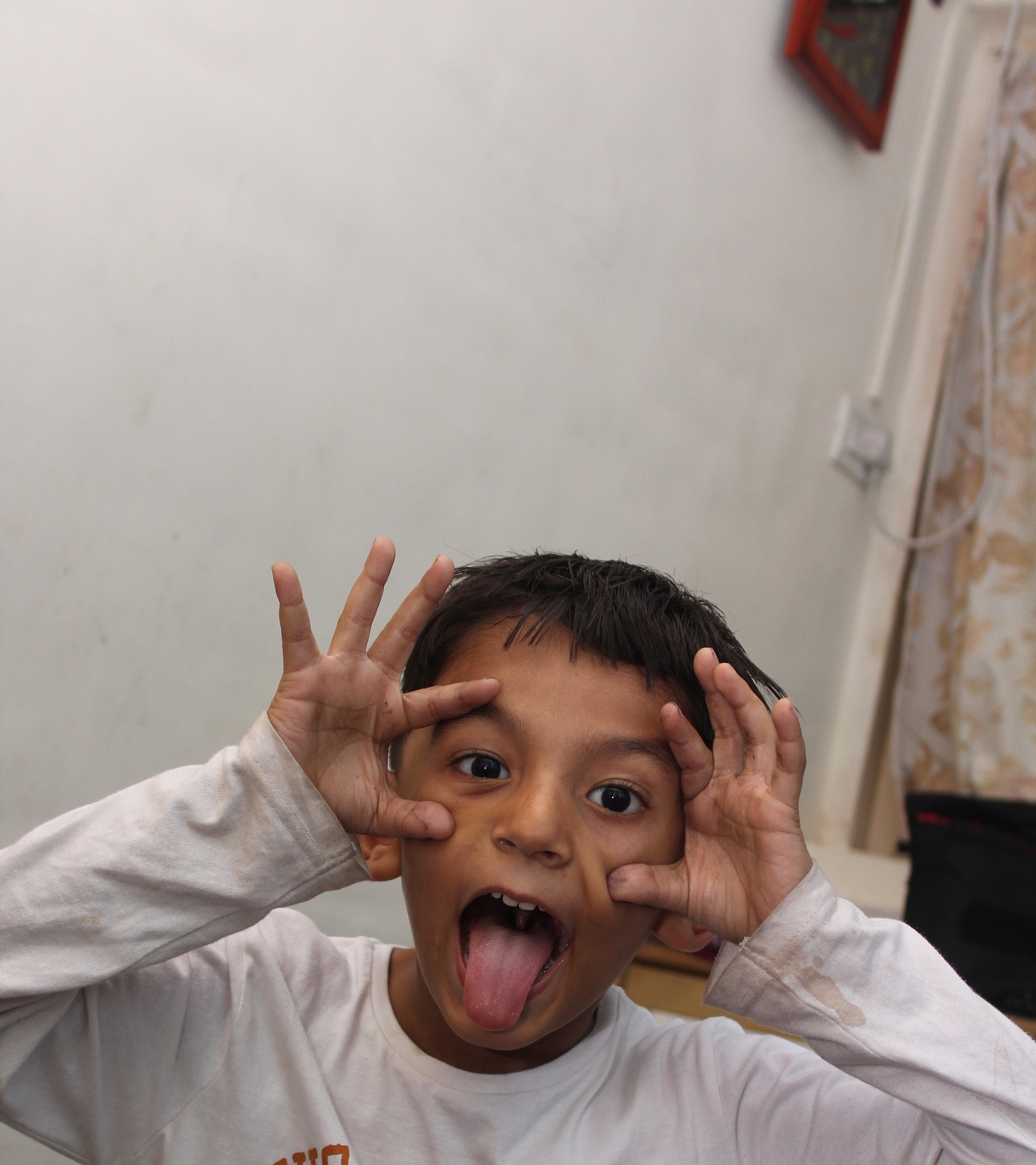 婴儿腿纹不一致怎么办