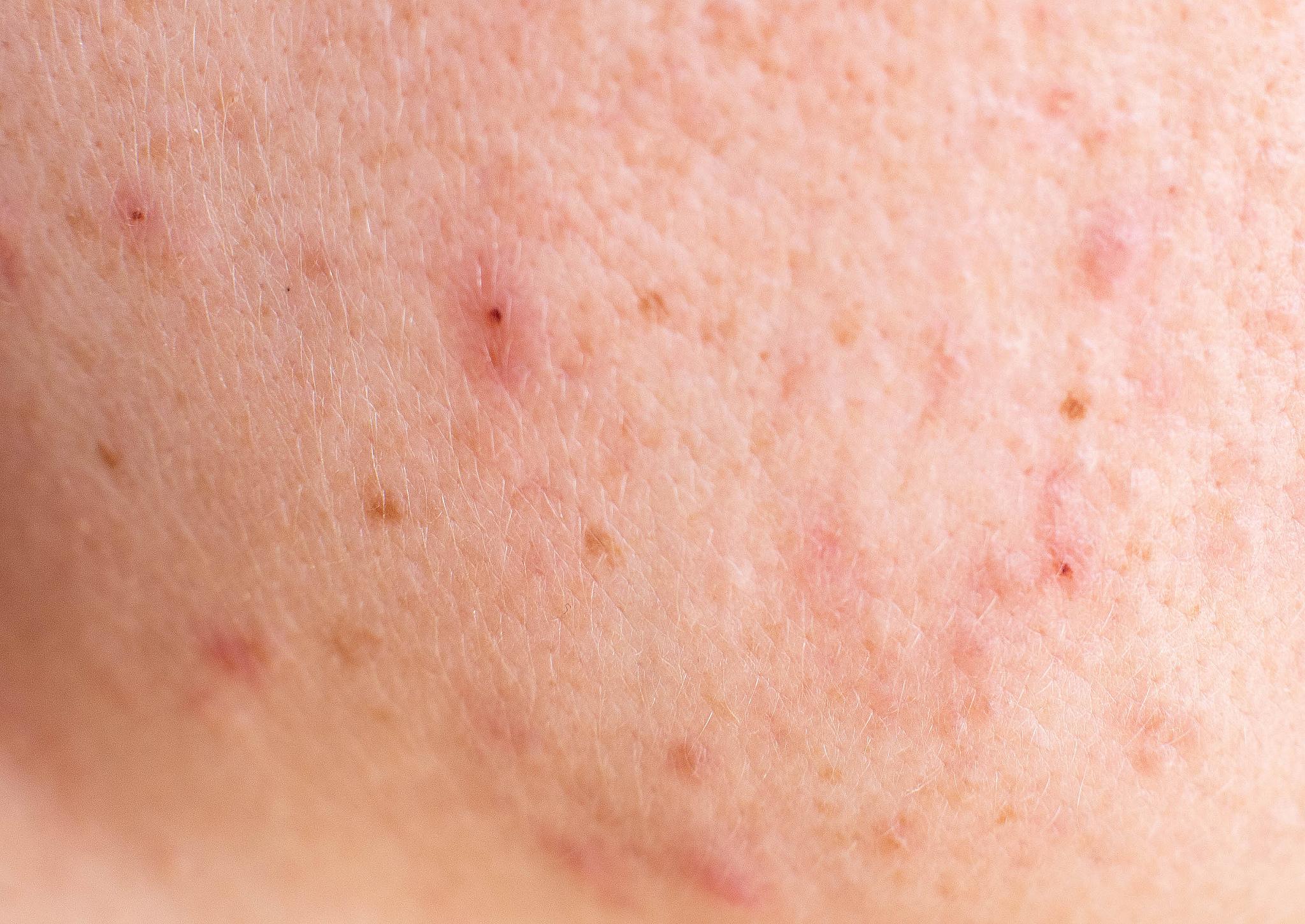 red acne on the girl's face, background, macro