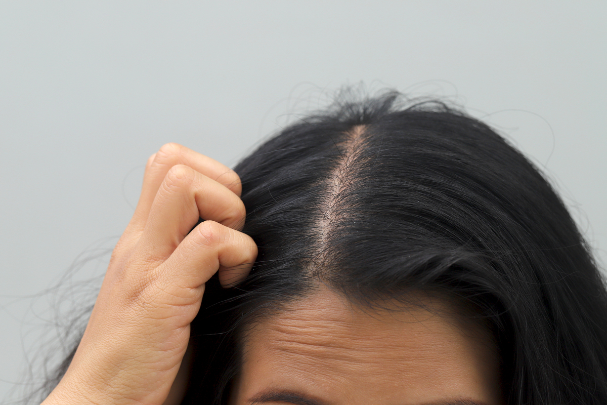 掉头发严重？警惕这几种常见原因！