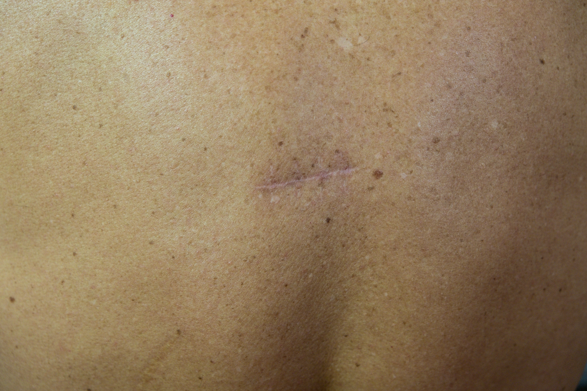there was a postoperative scar on the skin.
