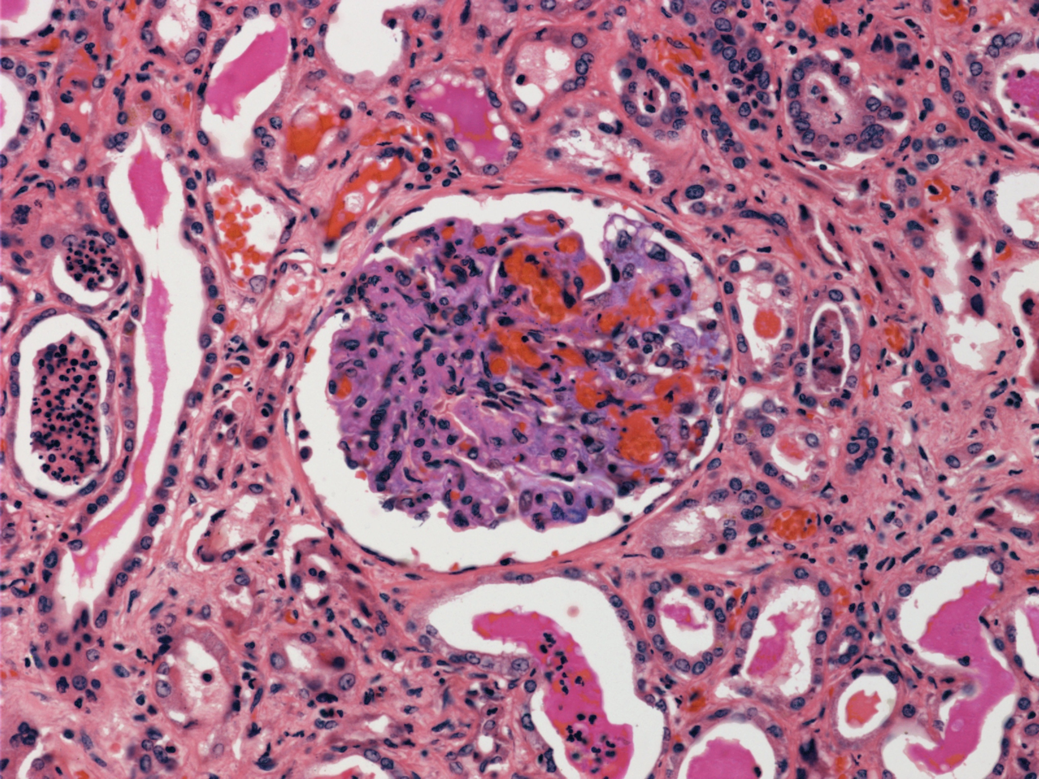 翻译：This article discusses the prognostic value of lymphovascular invasion LVI and perineural invasion PNI in stage III colon cancer The study found that LVI and PNI are important pathological factors