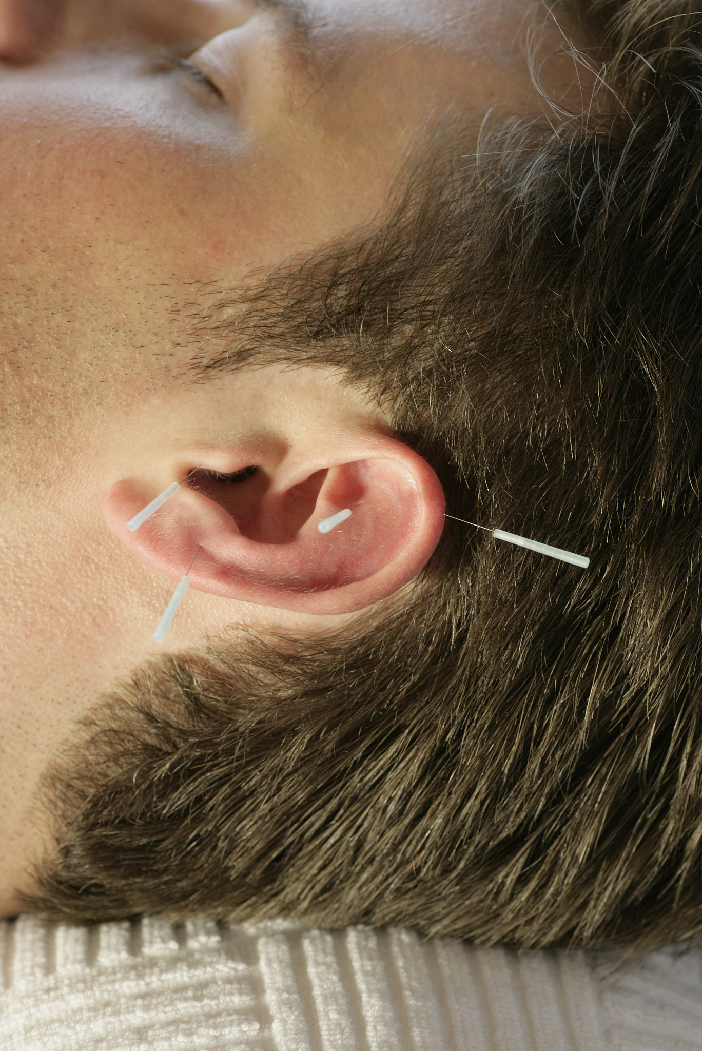man receiving acupuncture on ear