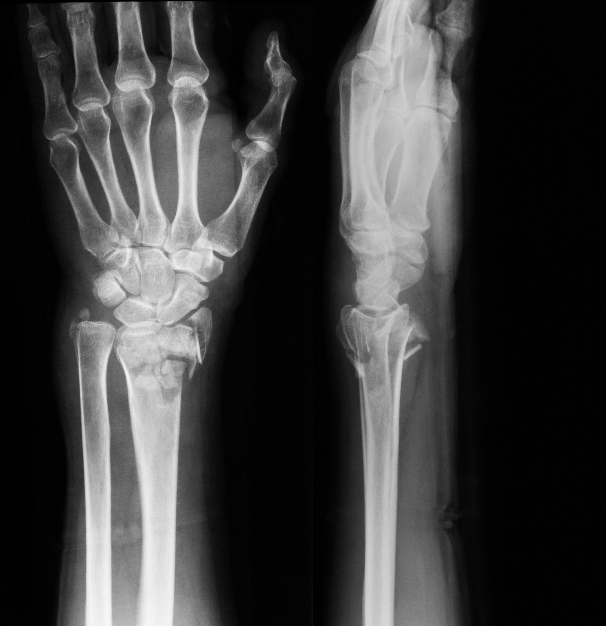 患者女66岁因春季疫情居家隔离满2周后外出采购日用品时摔倒髋部疼痛不能站起右手腕部疼痛、变形。经检查发现股骨颈和桡骨远端均骨折。请从解剖学角度分析该患者为什么容易发生骨折？