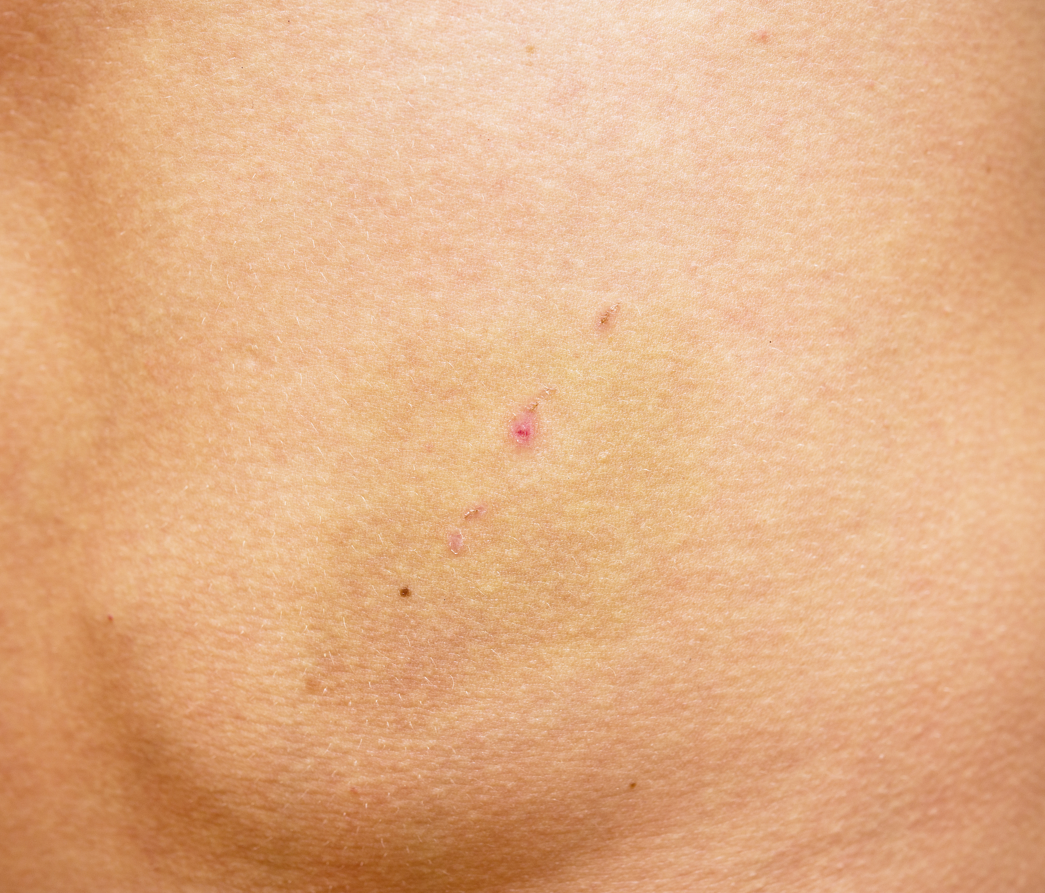 bruise