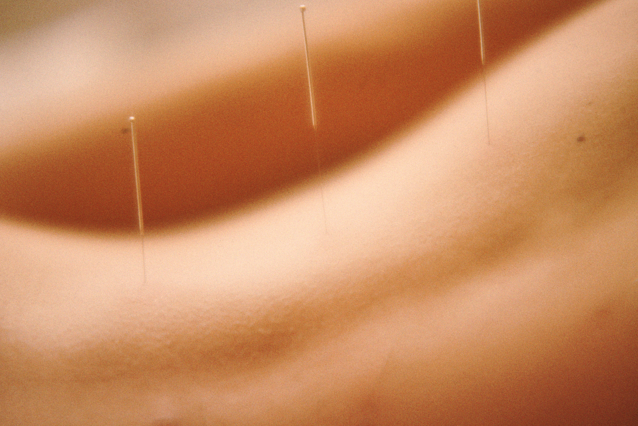 acupuncture