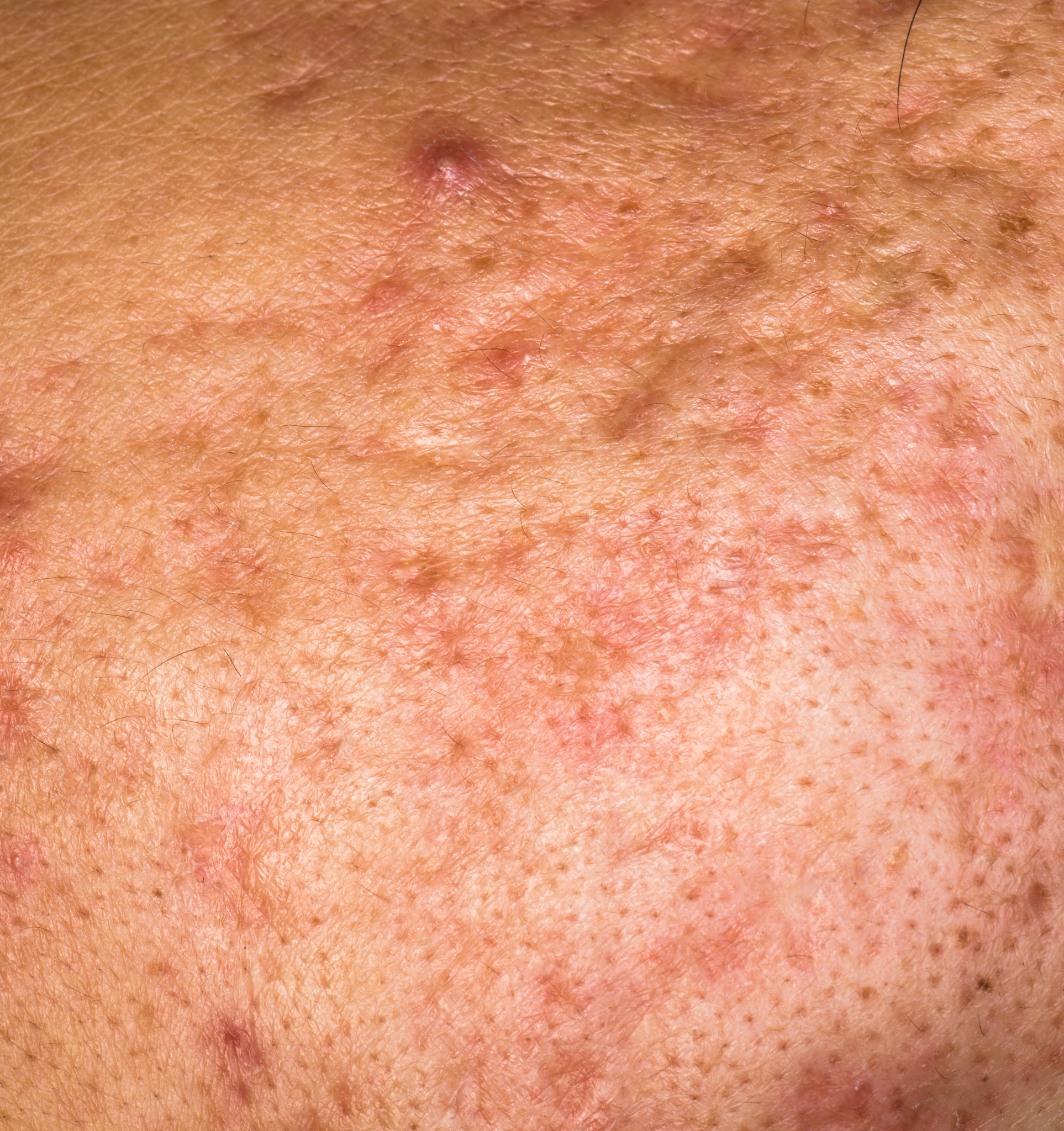whelk pimple skin texture