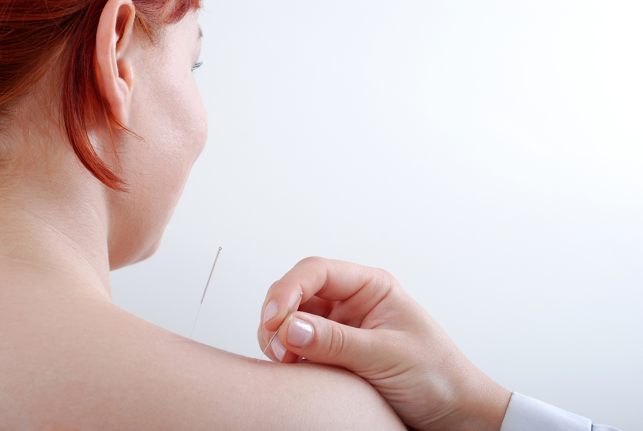 acupuncture