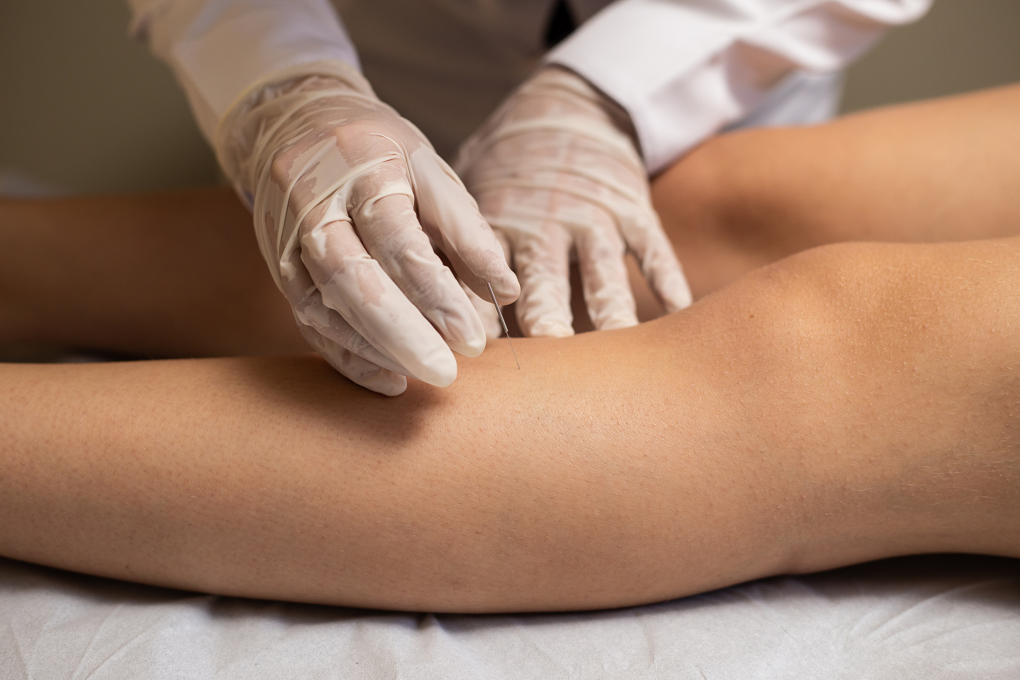 acupuncture.
