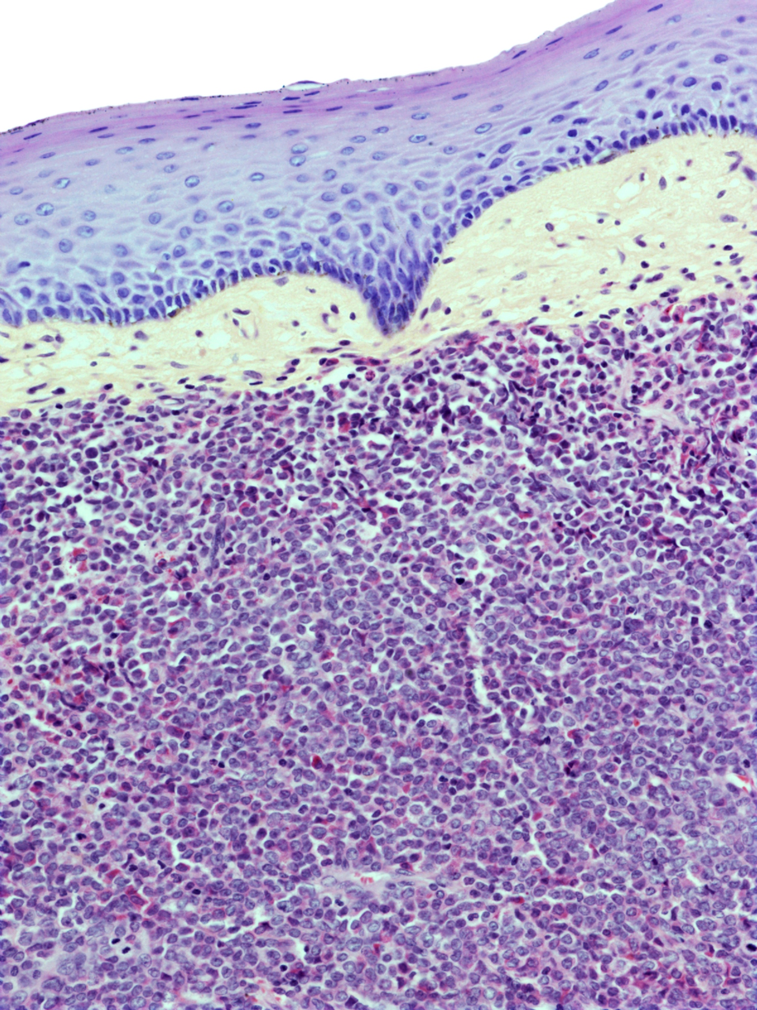 你是一个医生脖子右边淋巴结肿了按压痛怎么办
