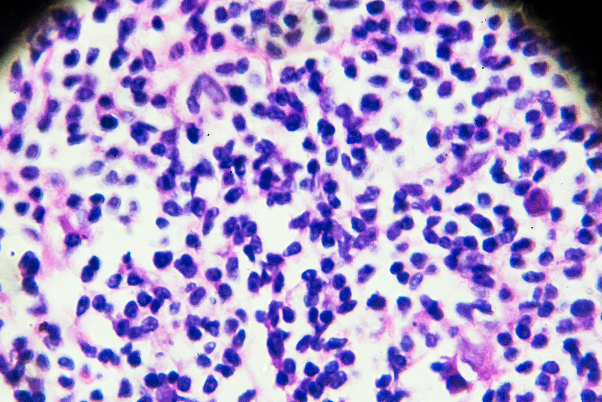 淋巴结增强轻度强化。这种情况是有问题吗