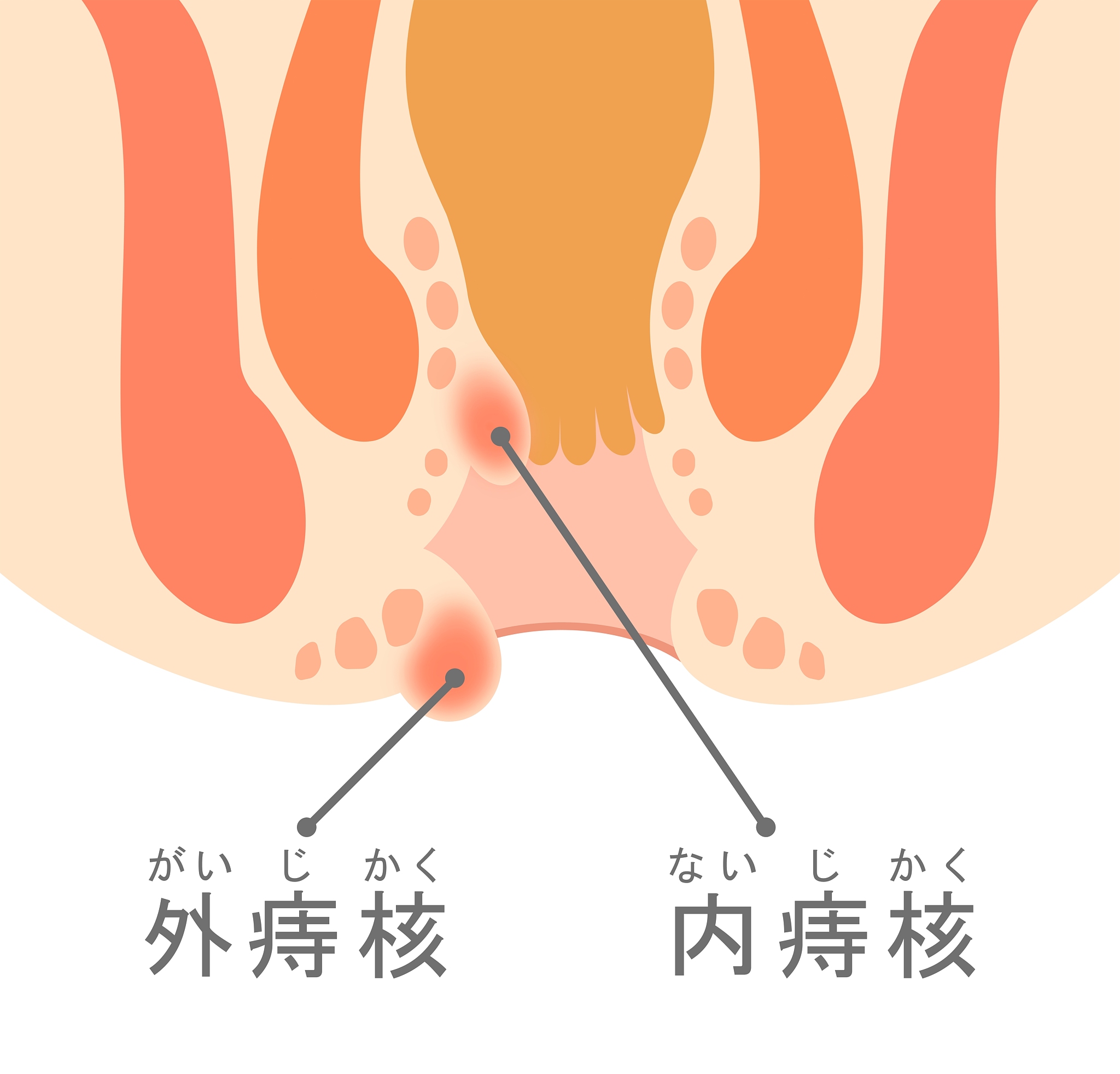 <strong>痔疮</strong>,肿胀的,横截面,健康保健,洞,中间部分,肠道,臀部,医疗图,括约肌