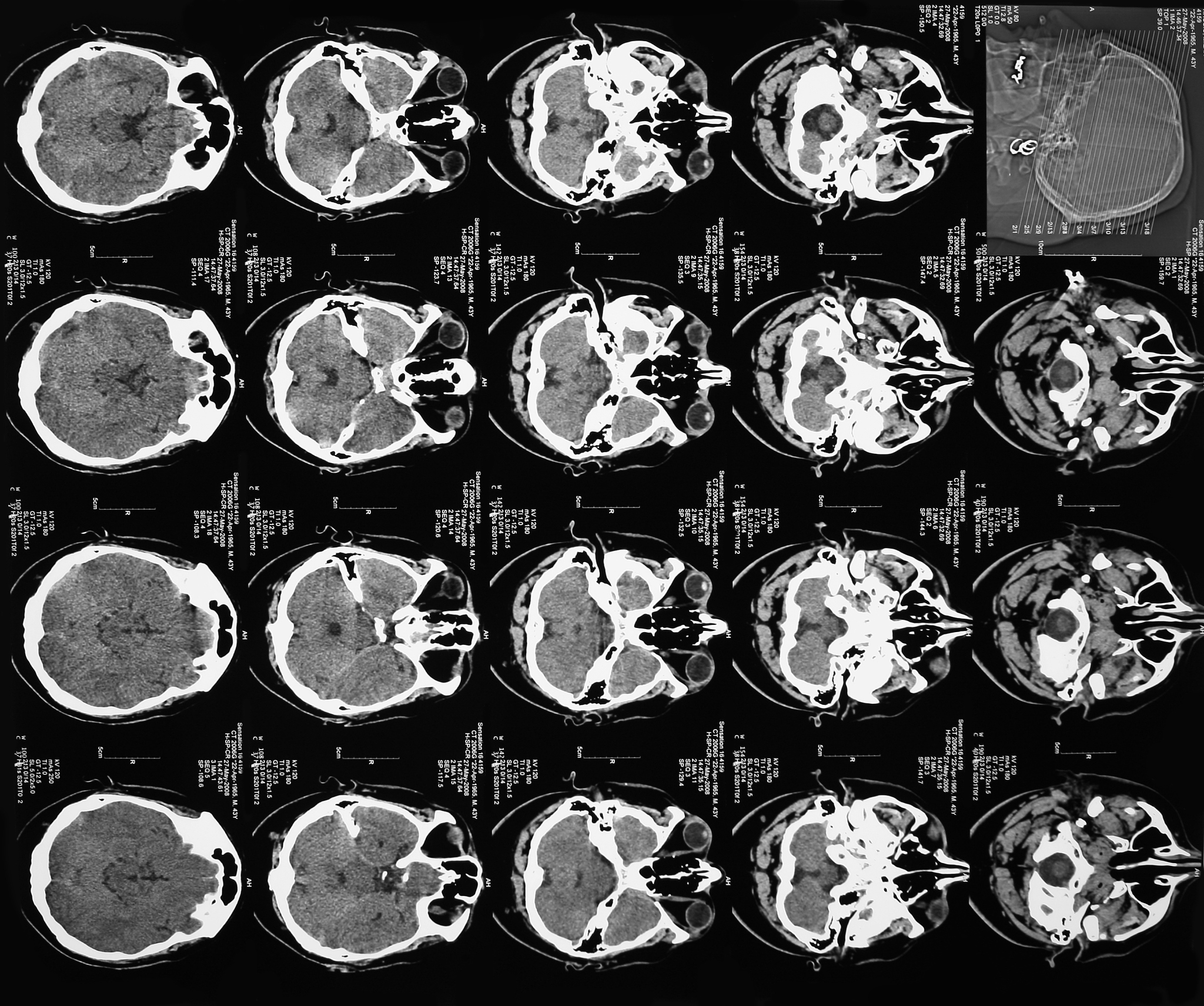 腺泡状软组织肉瘤的CT和MR诊断难度大么？