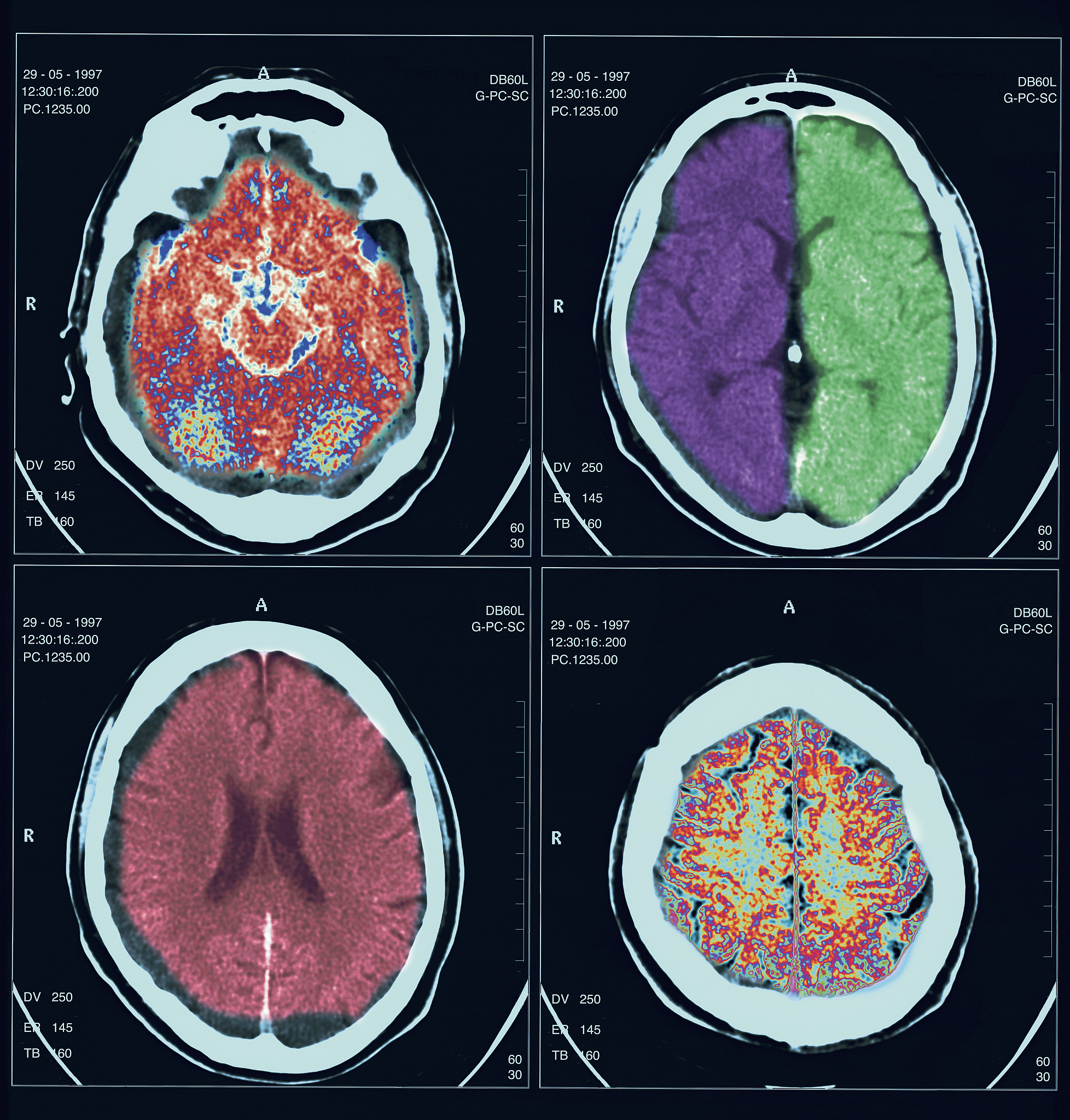 增强超声诊断易损颈动脉斑块破裂在急性脑卒中患者中的应用