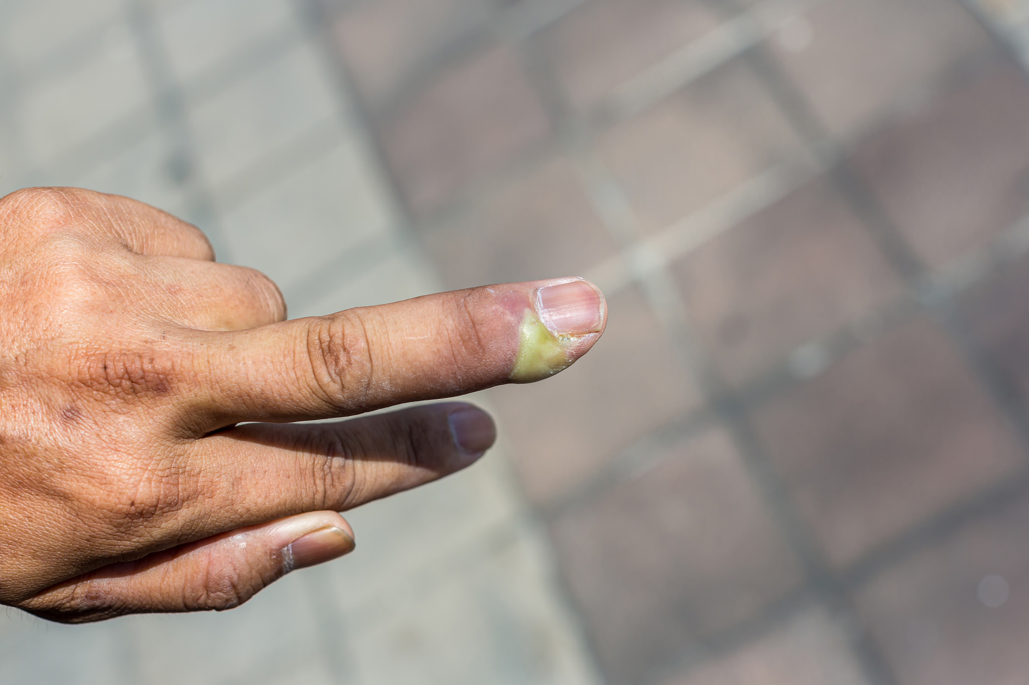 喝啤酒后手指头胀痛