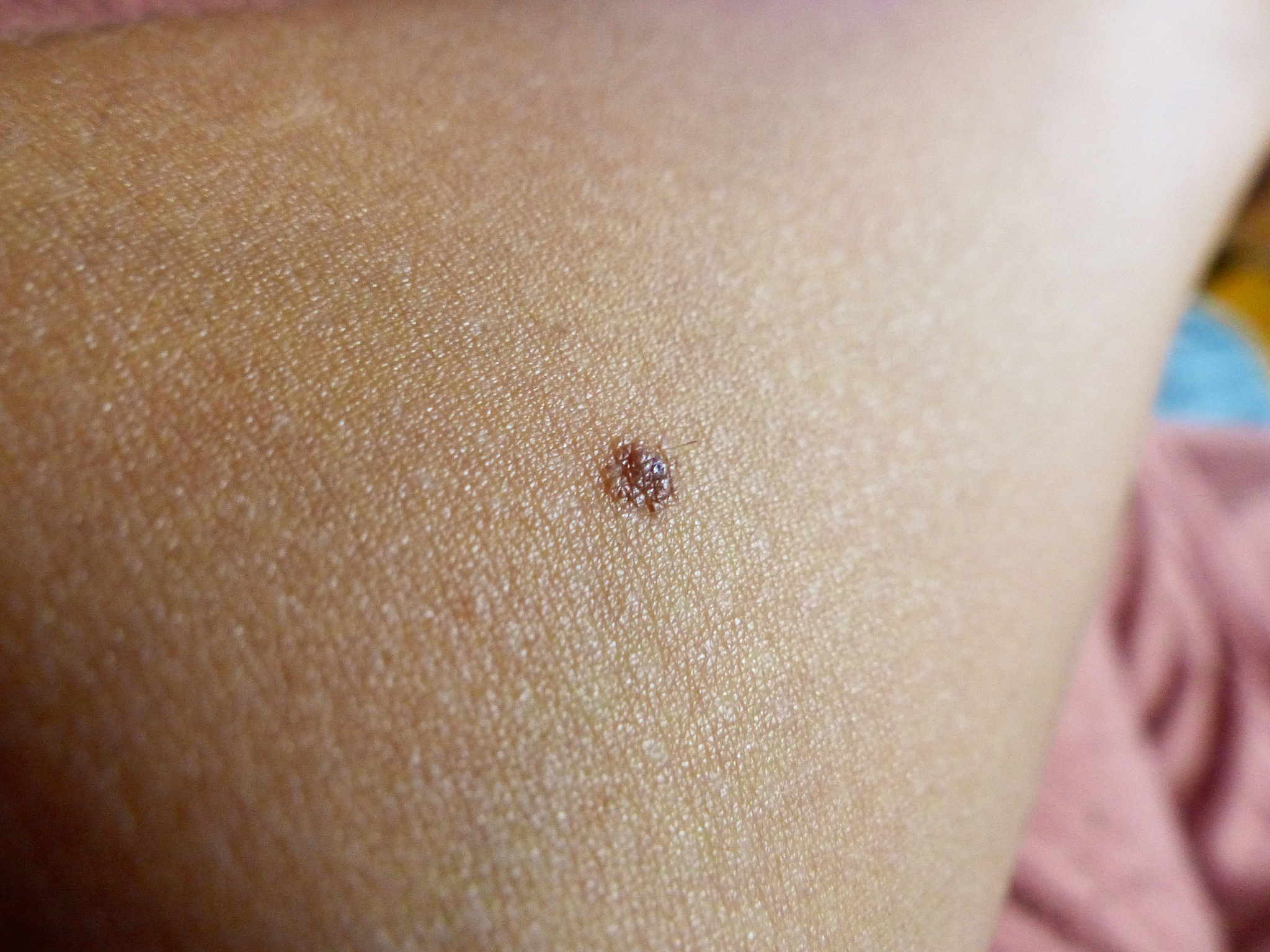 mole on arm