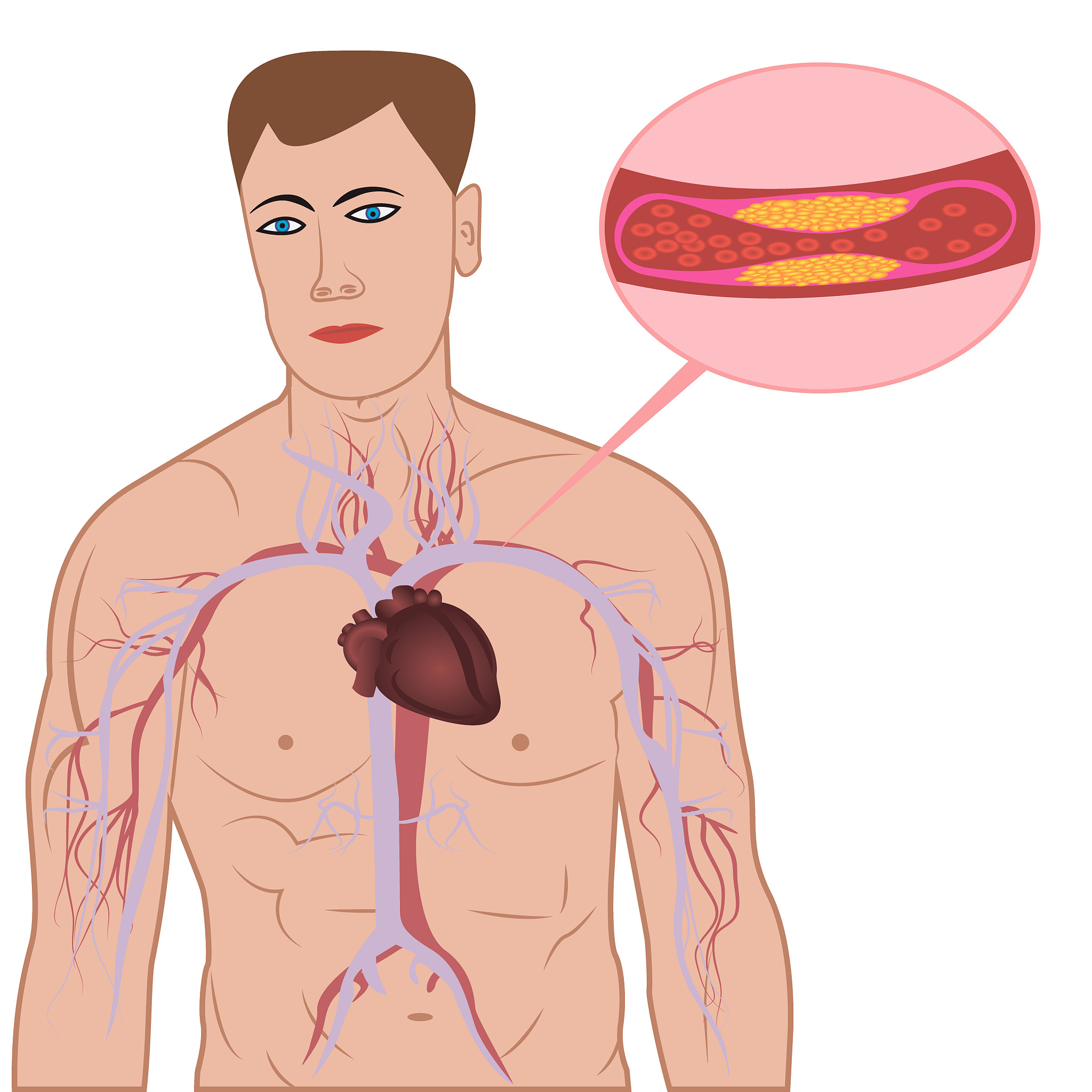 脑动脉供血不足合并糖尿病：症状、风险及治疗