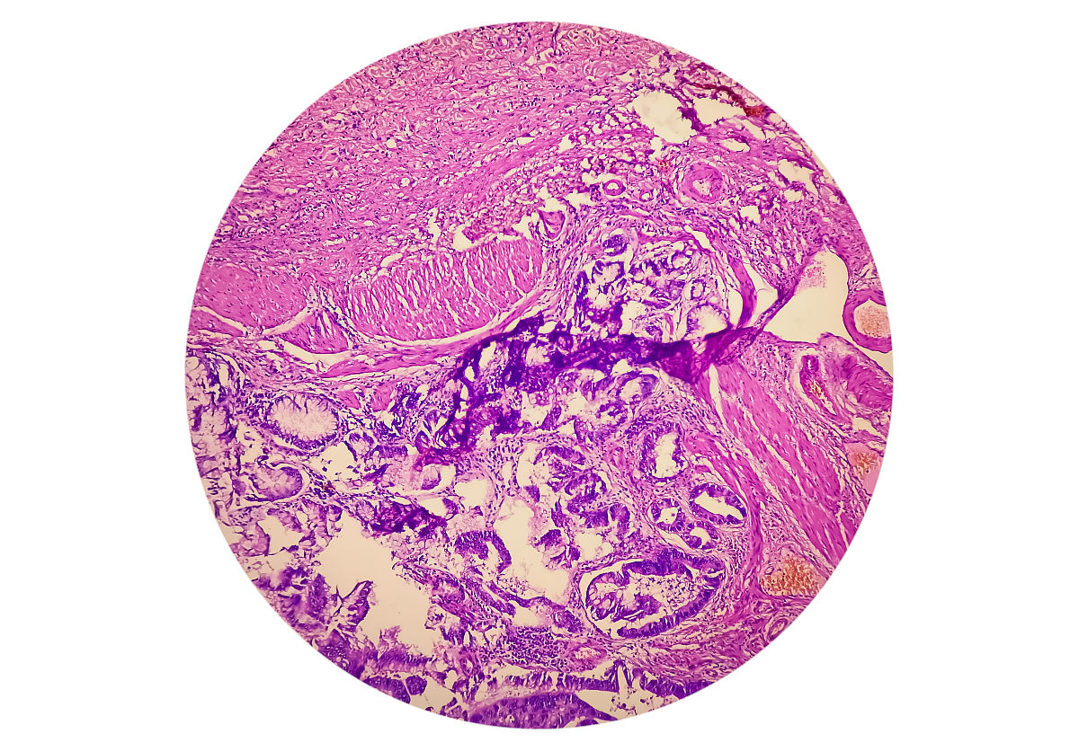 腹膜后肉瘤：罕见恶性肿瘤的综述