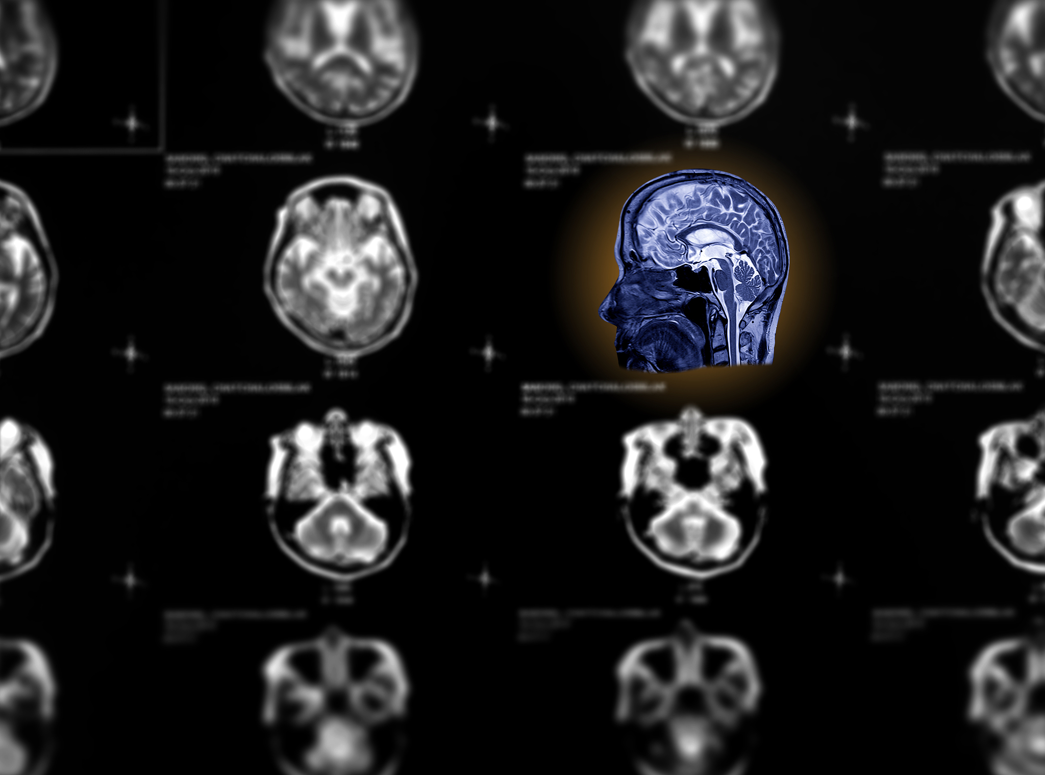 临床上常见的脑外伤包括A 	脑内出血B 	多发性陷入性颅骨骨折C 	硬膜下血肿D 	脑挫裂伤E 	急性脑水肿
