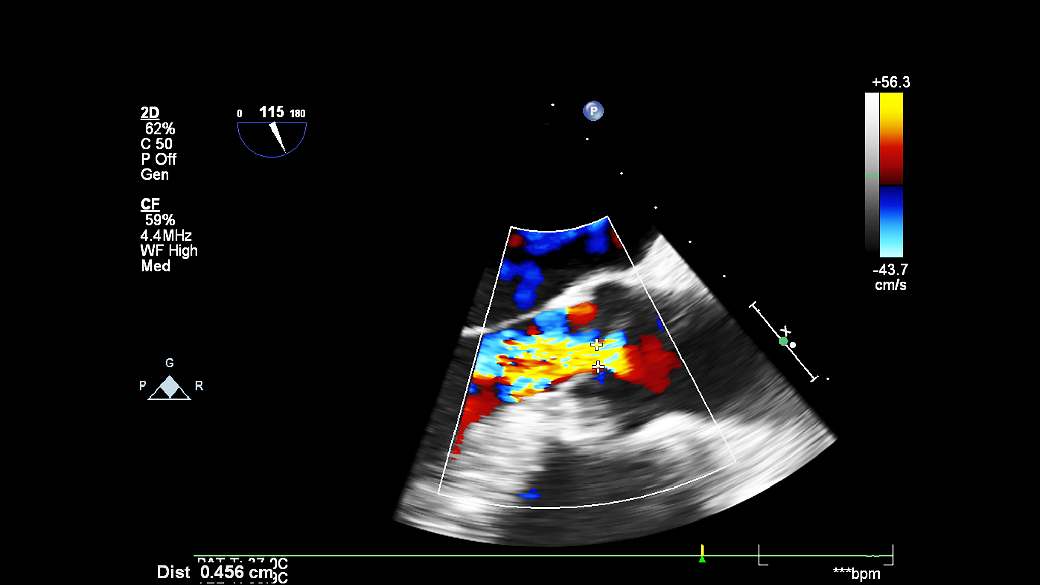 基于约束层的激光超声技术在金属缺陷深度定量评估中的应用 基于约束层的激光超声技术在金属缺陷深度定量评估中的应用