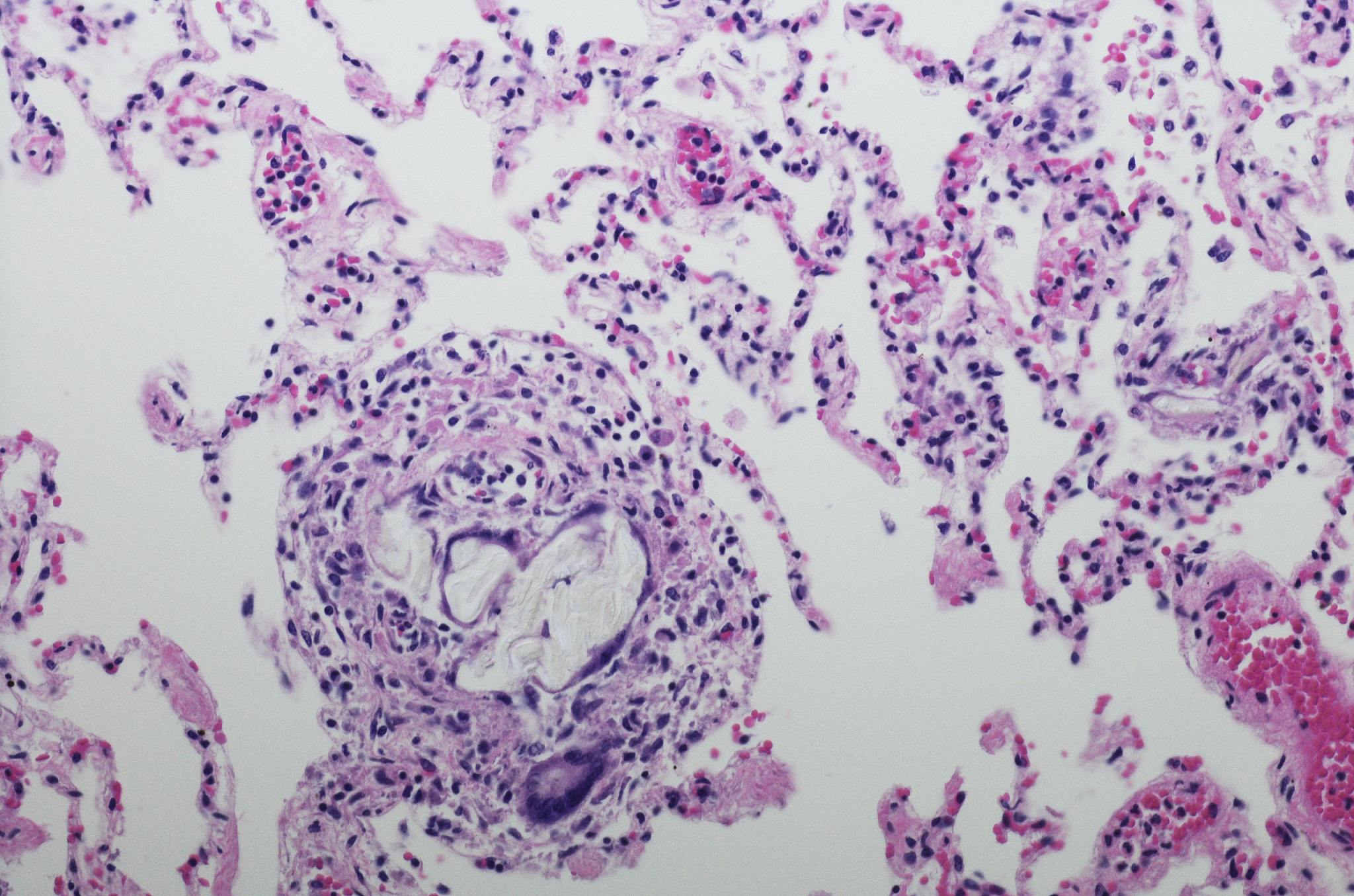 血性胸腔积液查无病因