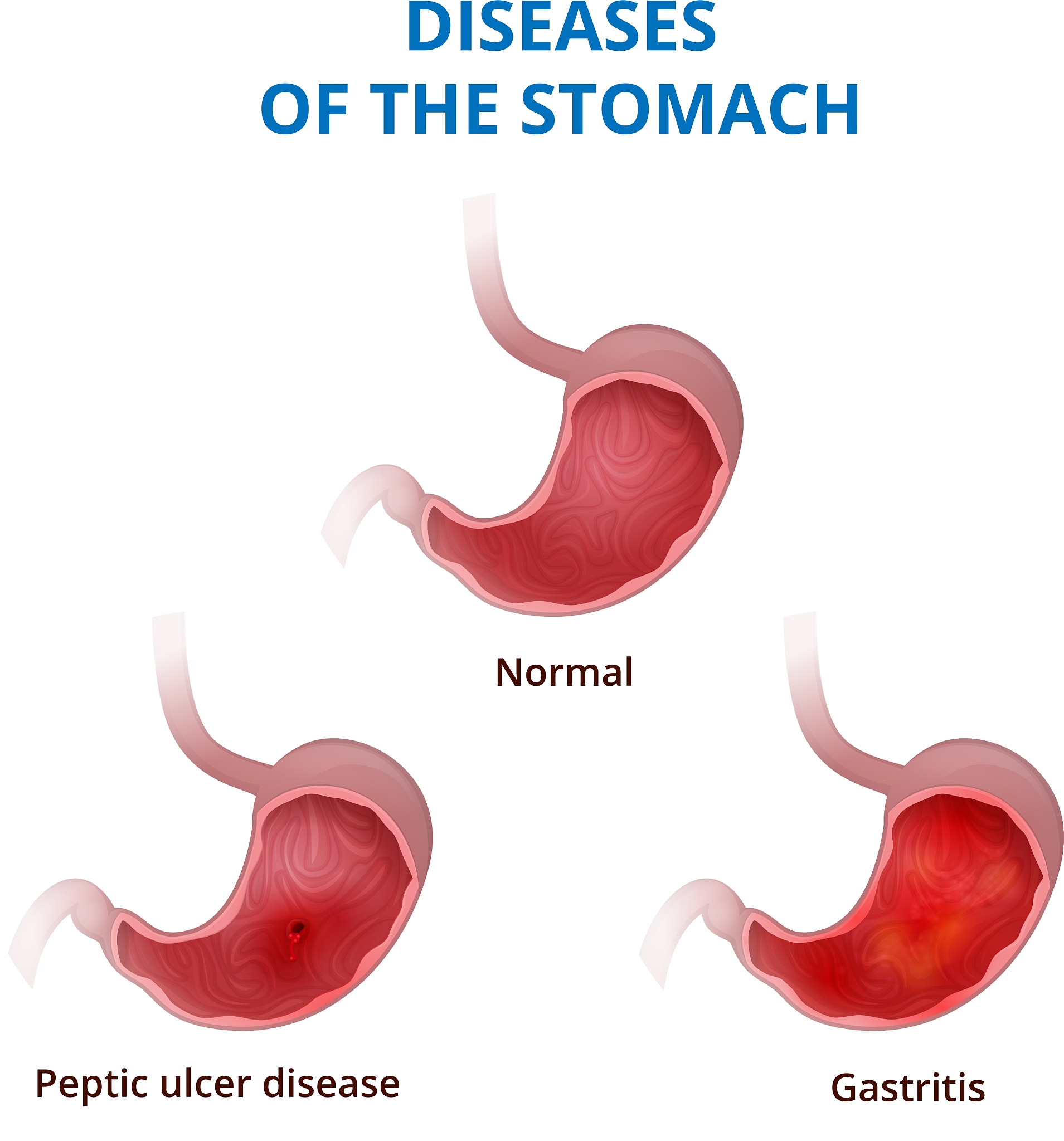 胃肿瘤高血压患者全胃切除术后呼吸护理指南