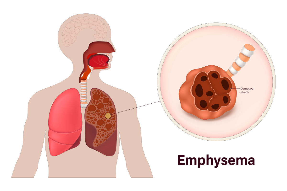 为什么人类这么脆弱人类脆弱的原因主要有以下几点：1 生理结构：人类体质相对其他动物来说较为脆弱我们没有像野兽那样强壮的肌肉和骨骼也没有像昆虫那样坚硬的外壳这使得我们更容易受伤。2 疾病：人类面临的各种疾病和病毒也是导致我们脆弱的重要原因。与其他动物相比我们更容易感染各种病毒和细菌并且某些疾病可能会导致我们失去免疫力或生命。3 精神状态：人类的心理和精神健康也会影响我们的脆弱程度。压力、焦虑、沮丧等