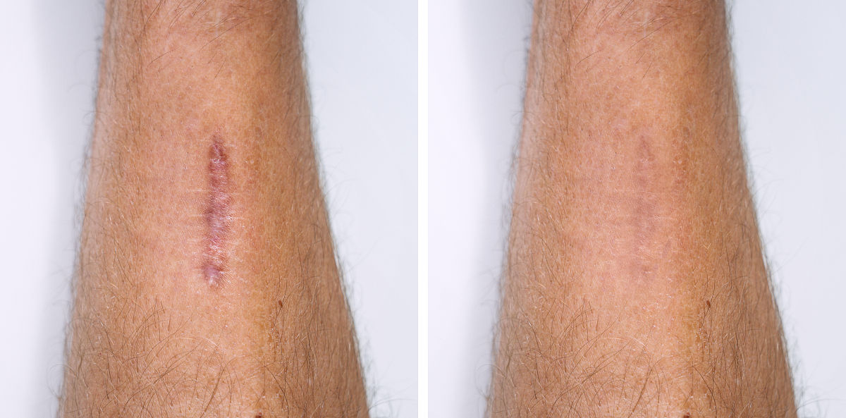 硬结型疤痕疙瘩药物治疗方法 - 硅凝胶、红花油等