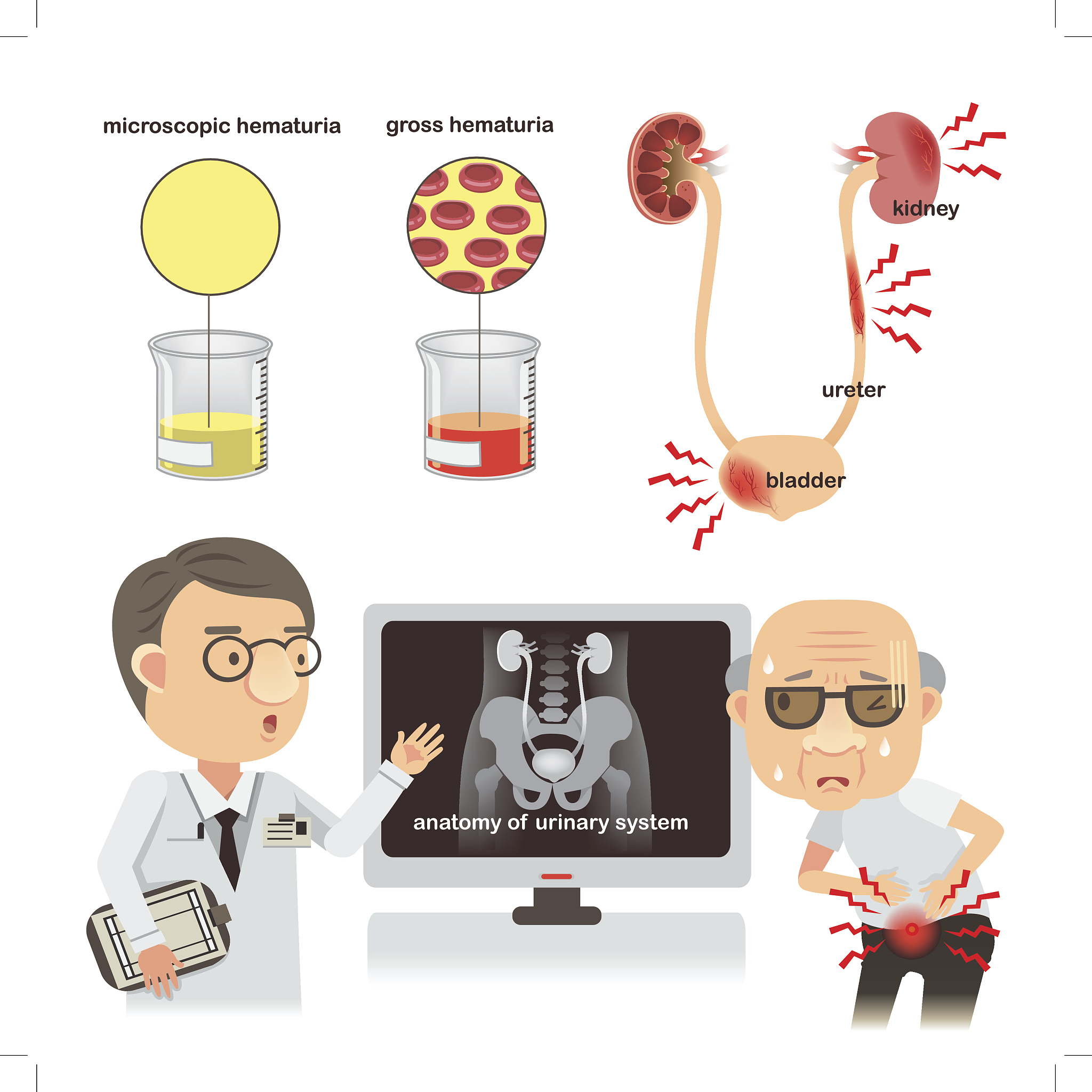 你的角色是一个专业的医师全腹部CT平扫提示：左肾下极巨大肿块CA肉瘤待排除。患者女55岁先已经排除肉瘤。目前考虑什么病。