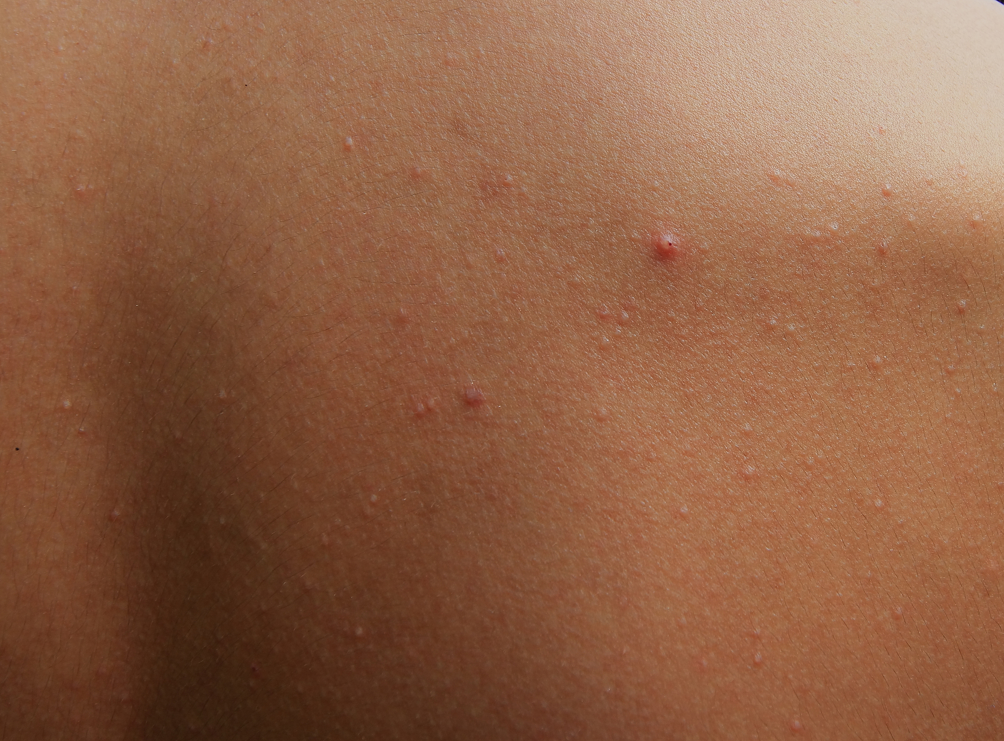 boy with problematic skin and acne scars in the back