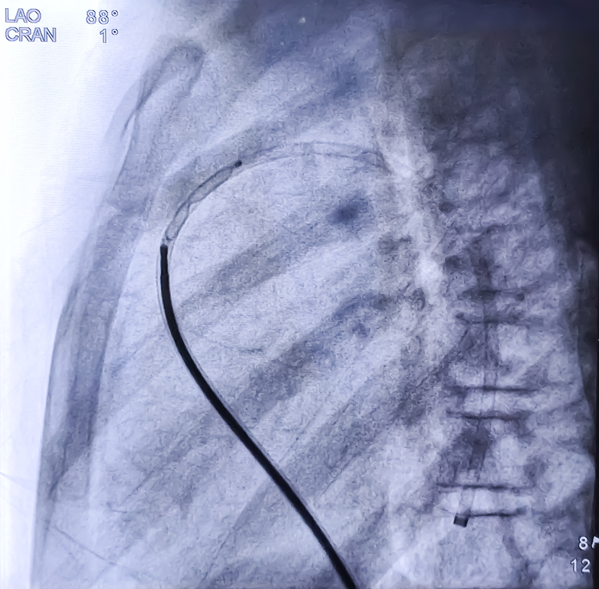 翻译：数字减影血管造影是诊断颈动脉病变的金标准但DSA作为一项侵入性检查有辐射费用也比较昂贵且不能显示斑块内新生血管和微小的溃疡。