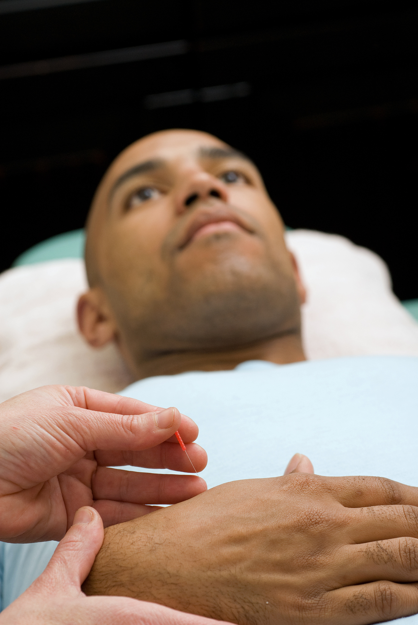 acupuncture