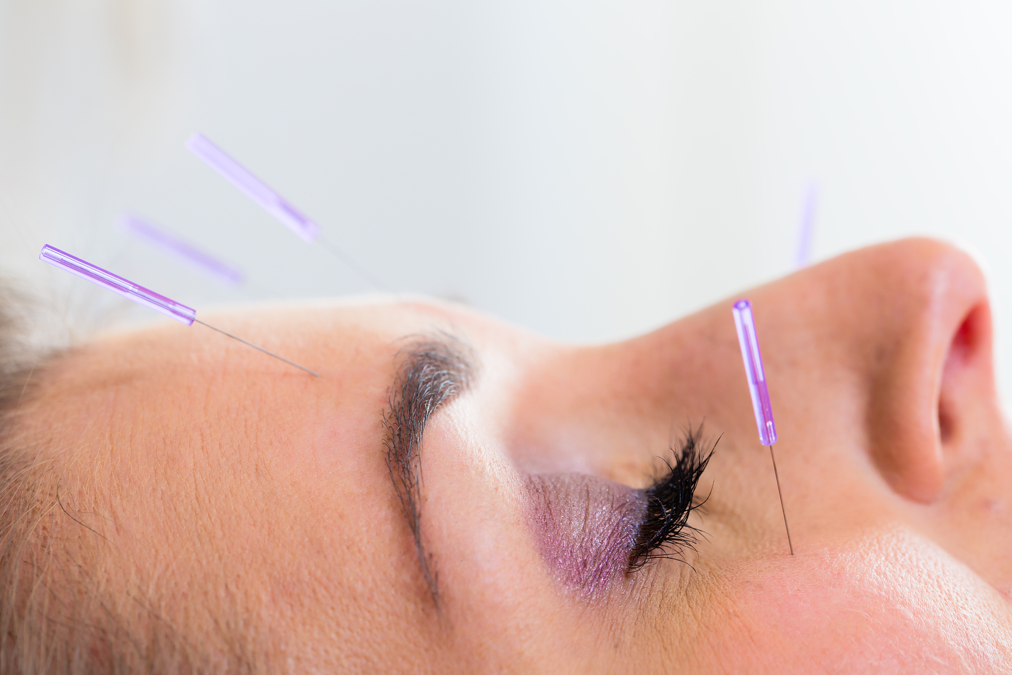 woman at acupuncture with needles in face