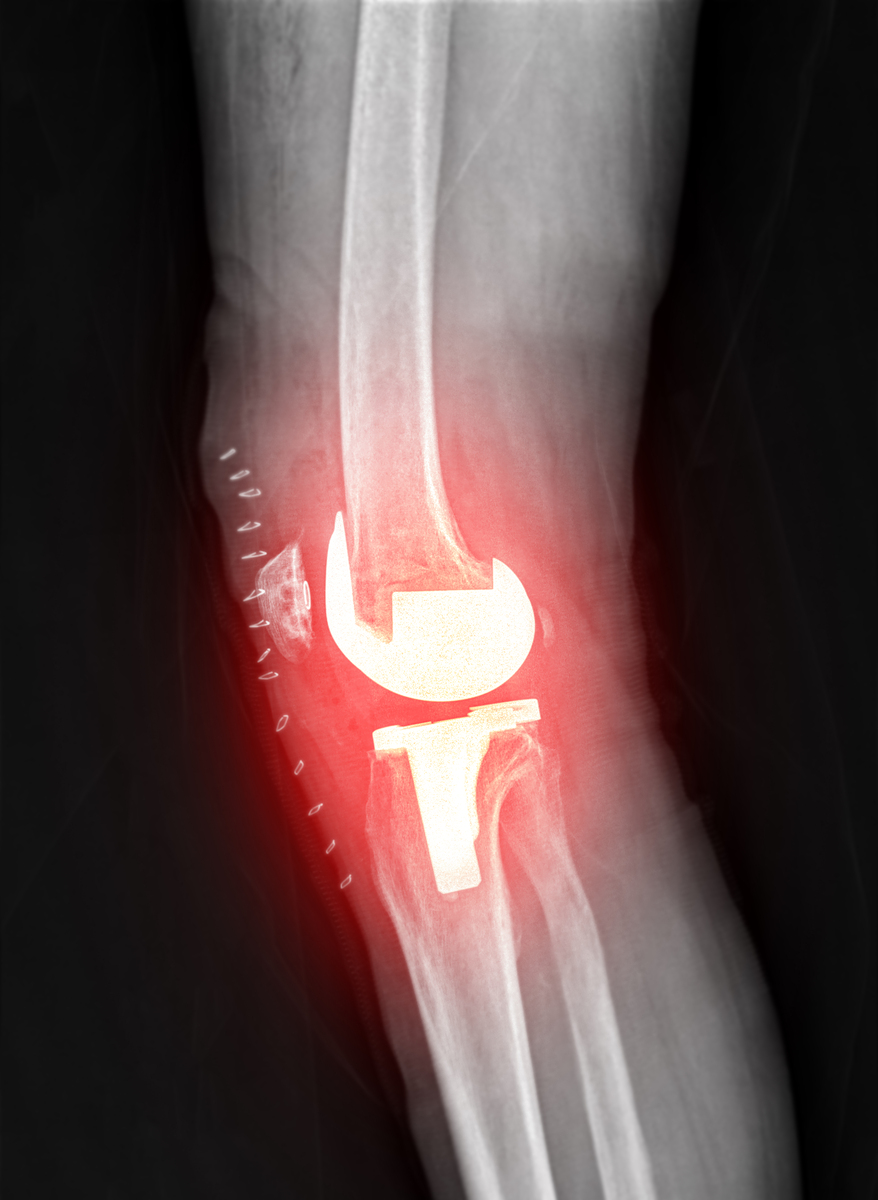 膝盖骨关节炎疼痛：最佳治疗方法及预防措施