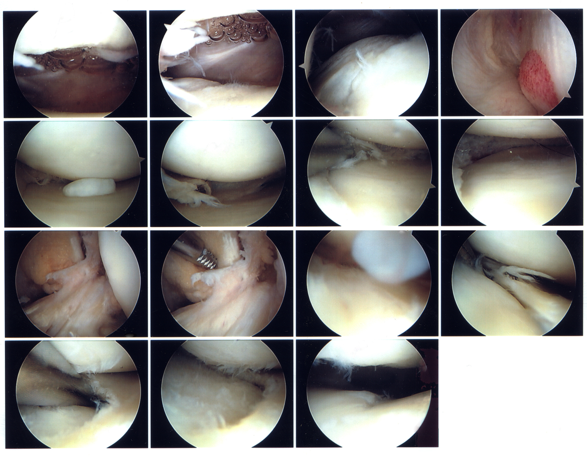 闭合性胸腹部损伤合并创伤性脾破裂腹腔镜探查备剖腹探查术的护理