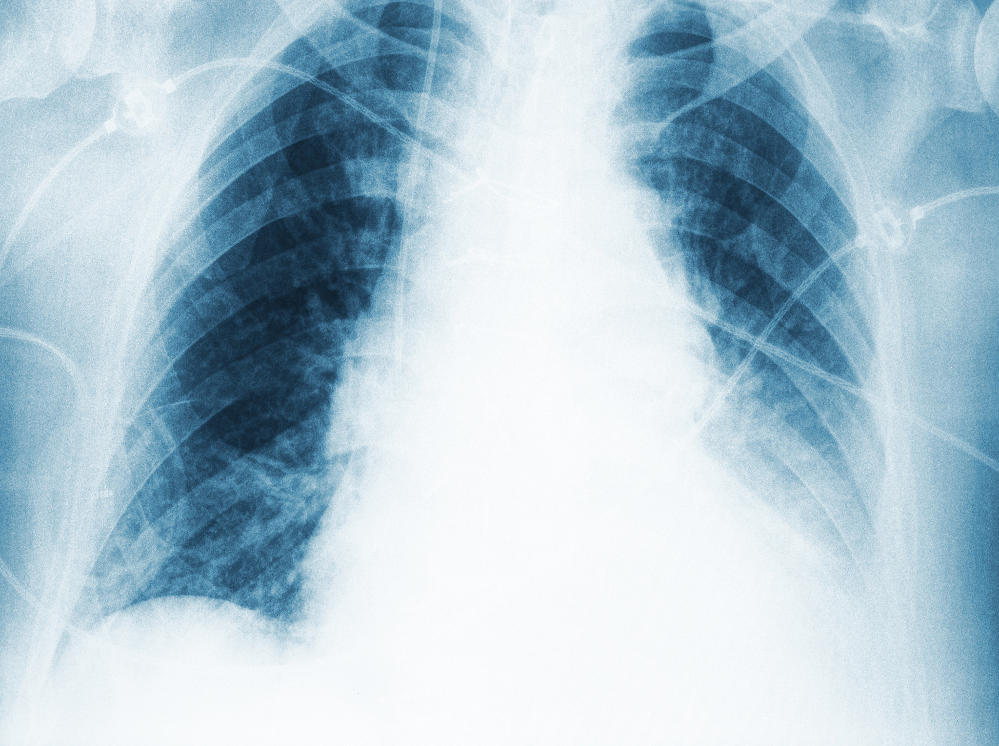 老年慢性阻塞性肺疾病 (COPD) 病人肺部信息需求调查：影响因素及自我管理计划