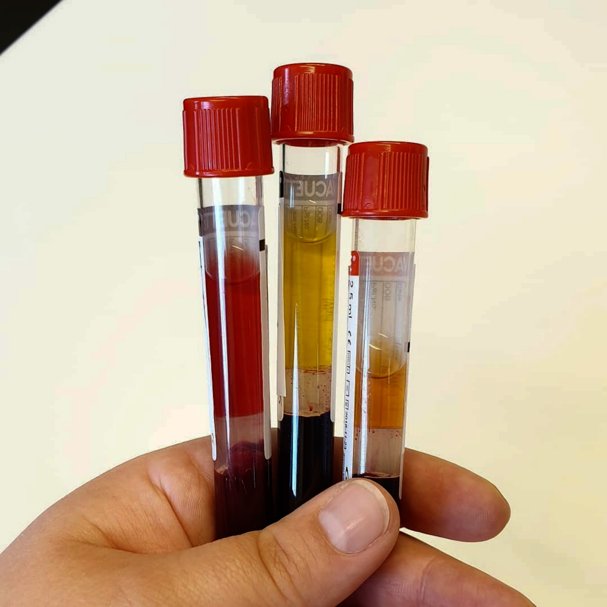 从尿液样本中分离、培养和鉴定微生物病原体：完整步骤与技术