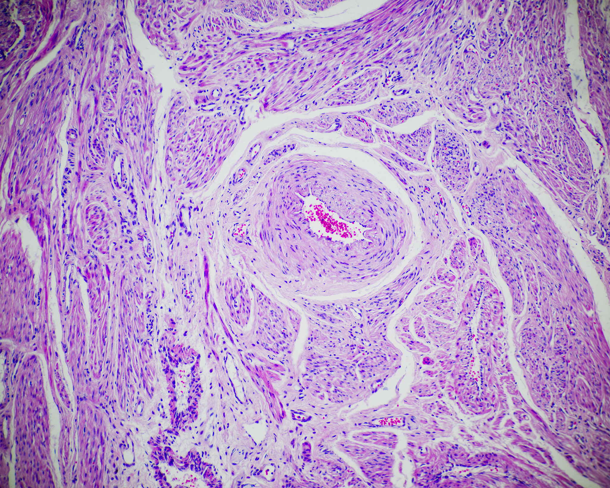 子宫肌瘤：症状、治疗及预防
