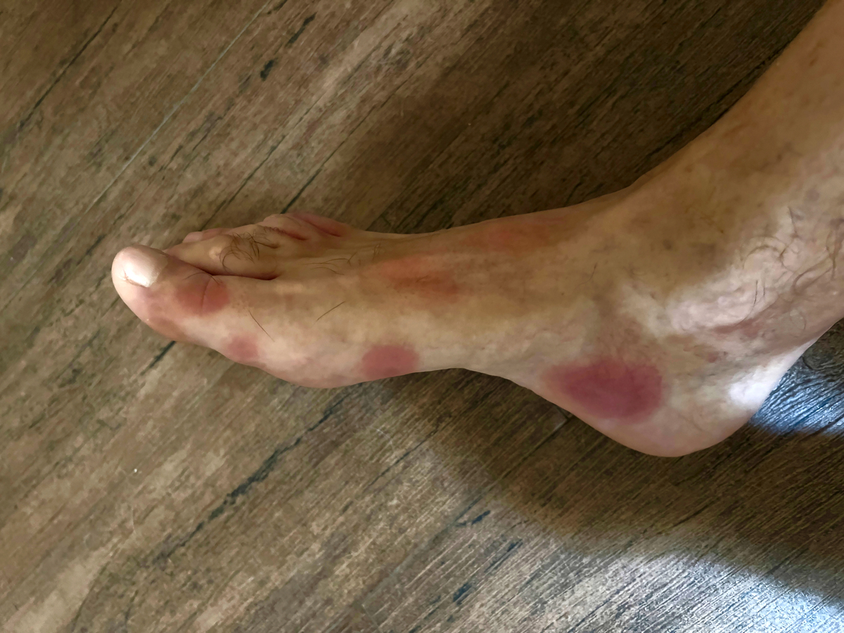 脚后跟肿胀的原因及处理方法