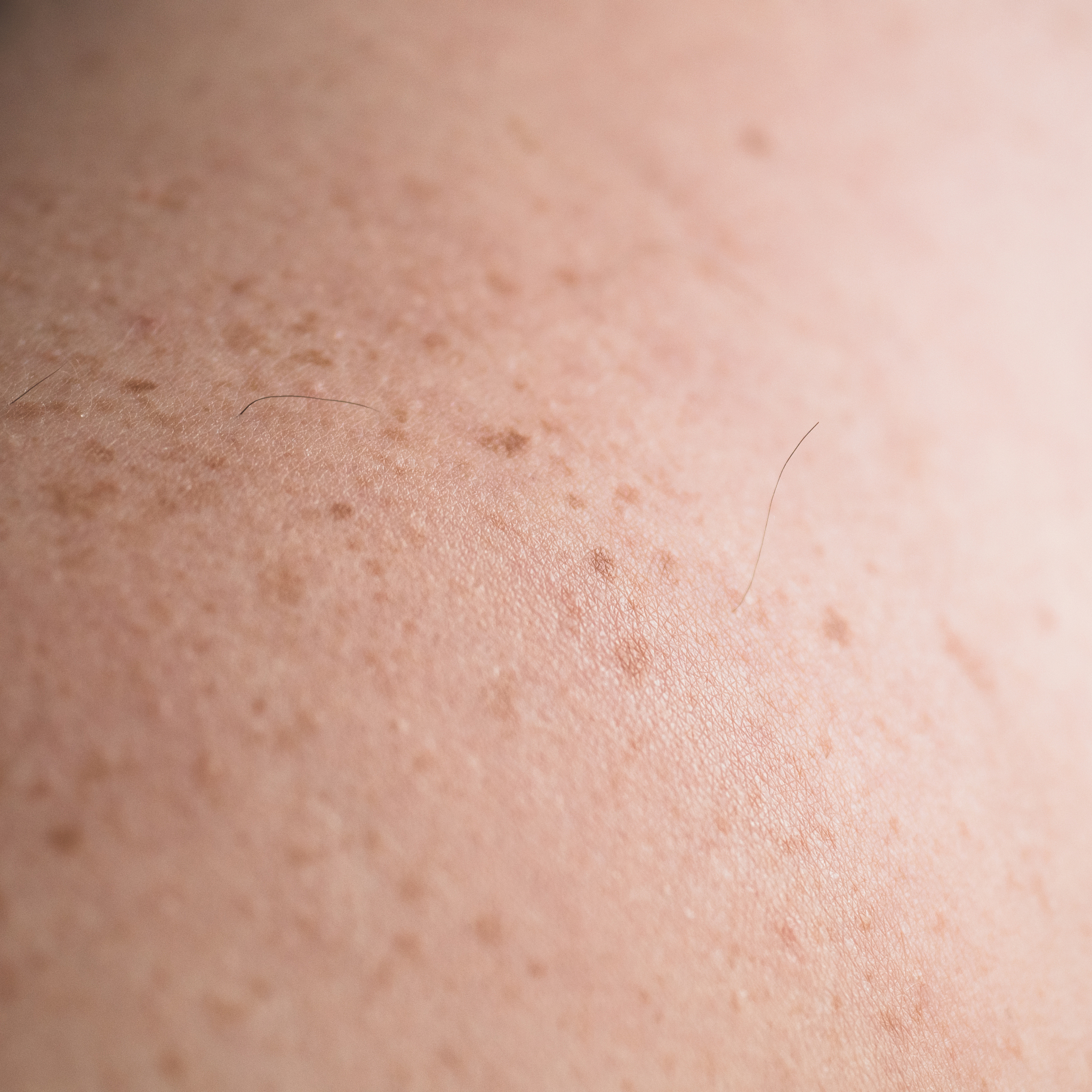 checking benign moles. close up detail of the bare skin on a man