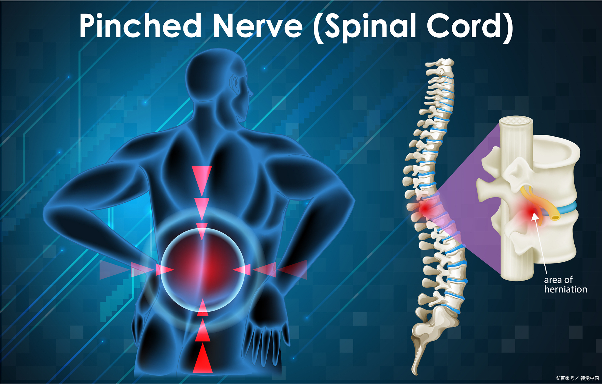 为什么会发生脊髓损伤？ - 脉脉