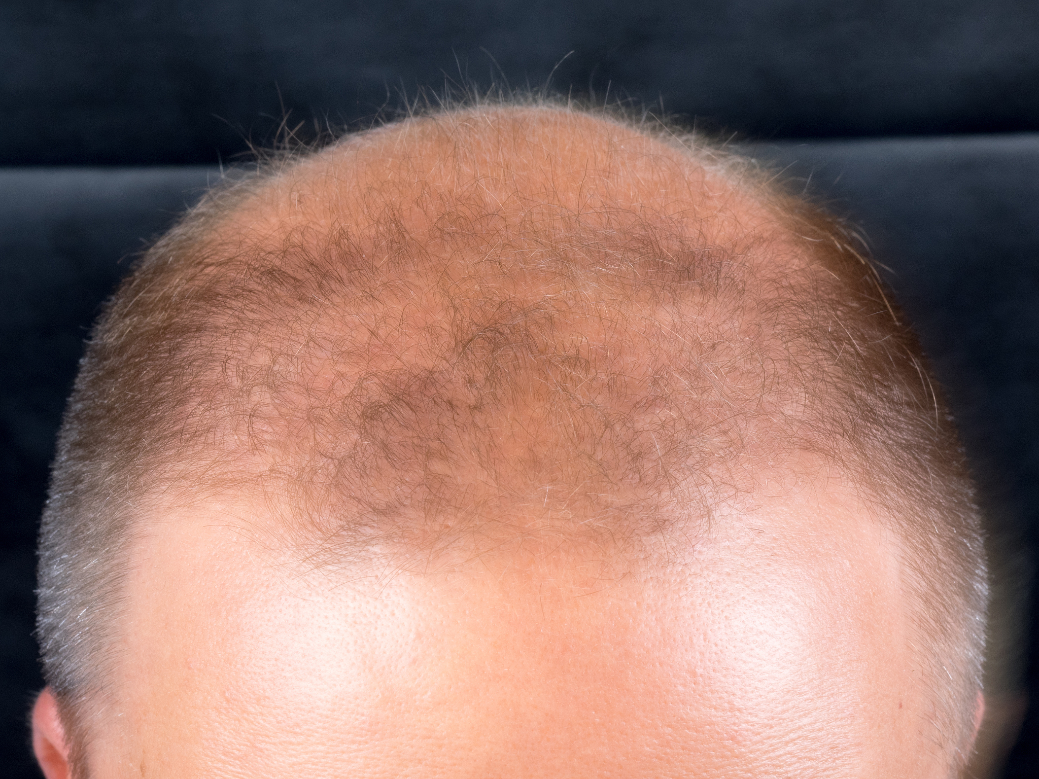 专业生发药：重拾自信，展现全新自我