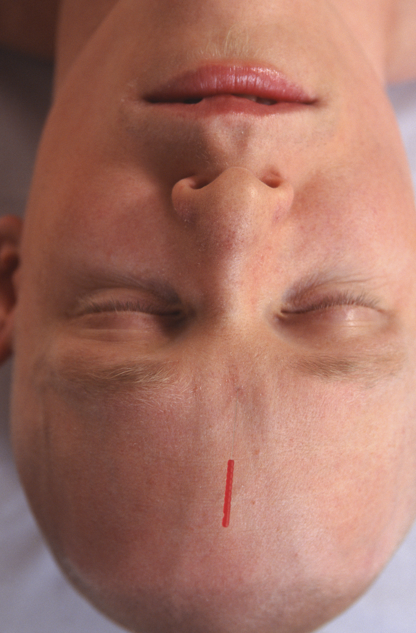 man lying down having acupuncture, close-up of head, close-up