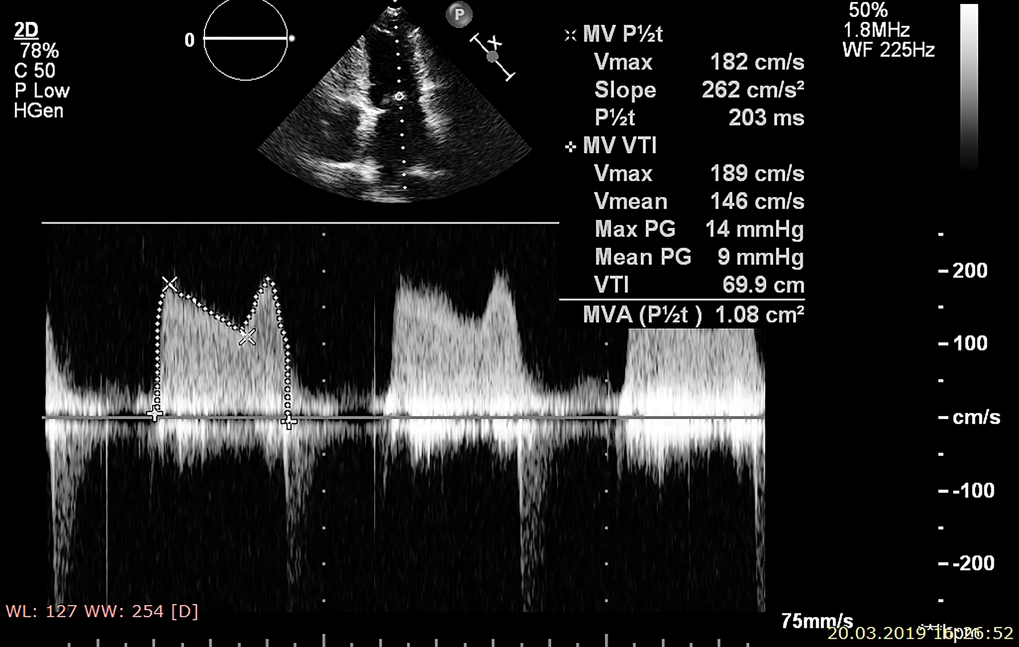 翻译Then electromagnetic fields discontinuities across the can be described using RSBC as 13