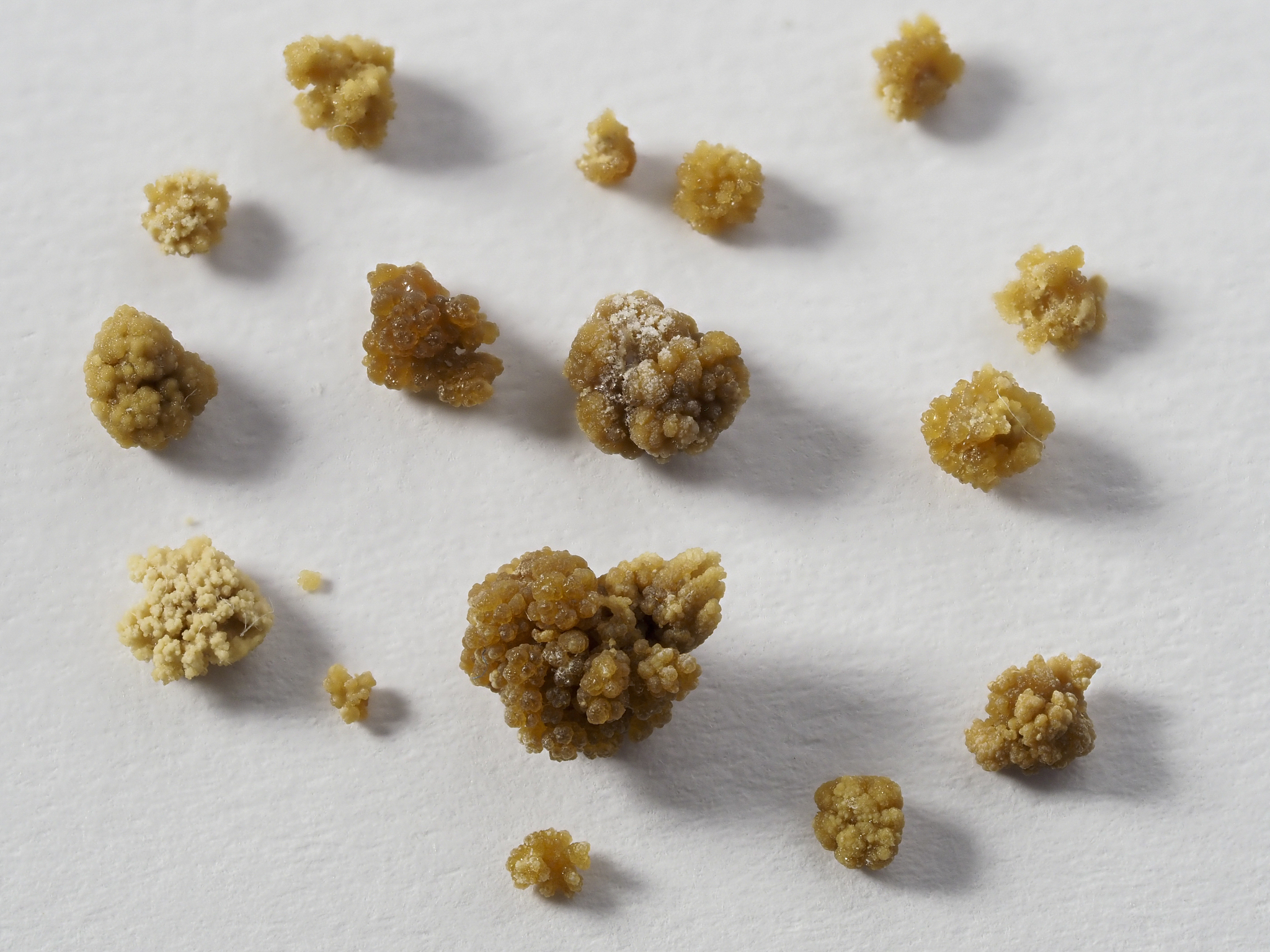 从泌尿外科医生的角度写一篇泌尿系结石的科普文章