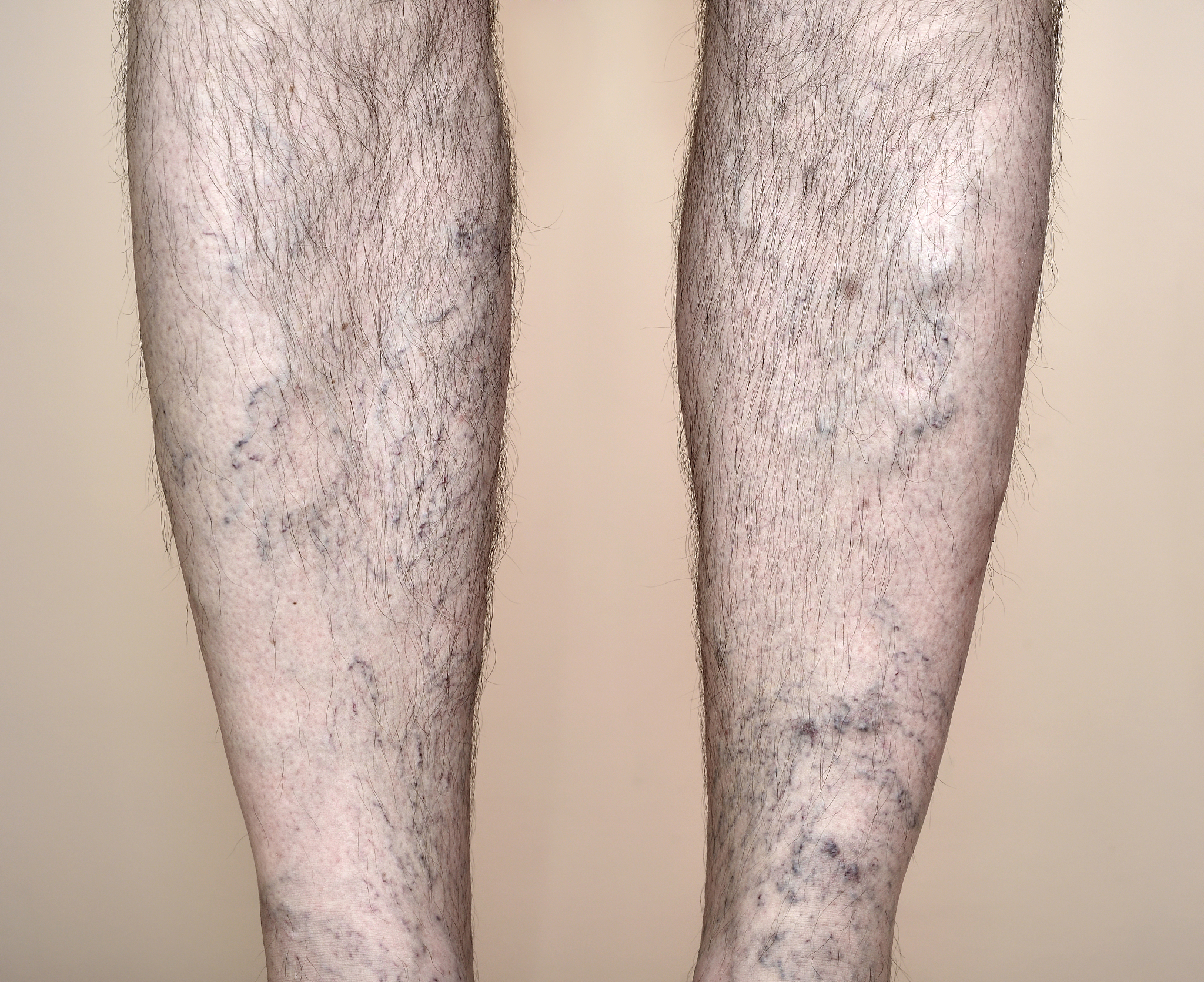 写一个护理专业调研与静脉曲张宣教实践过程简短200字以内