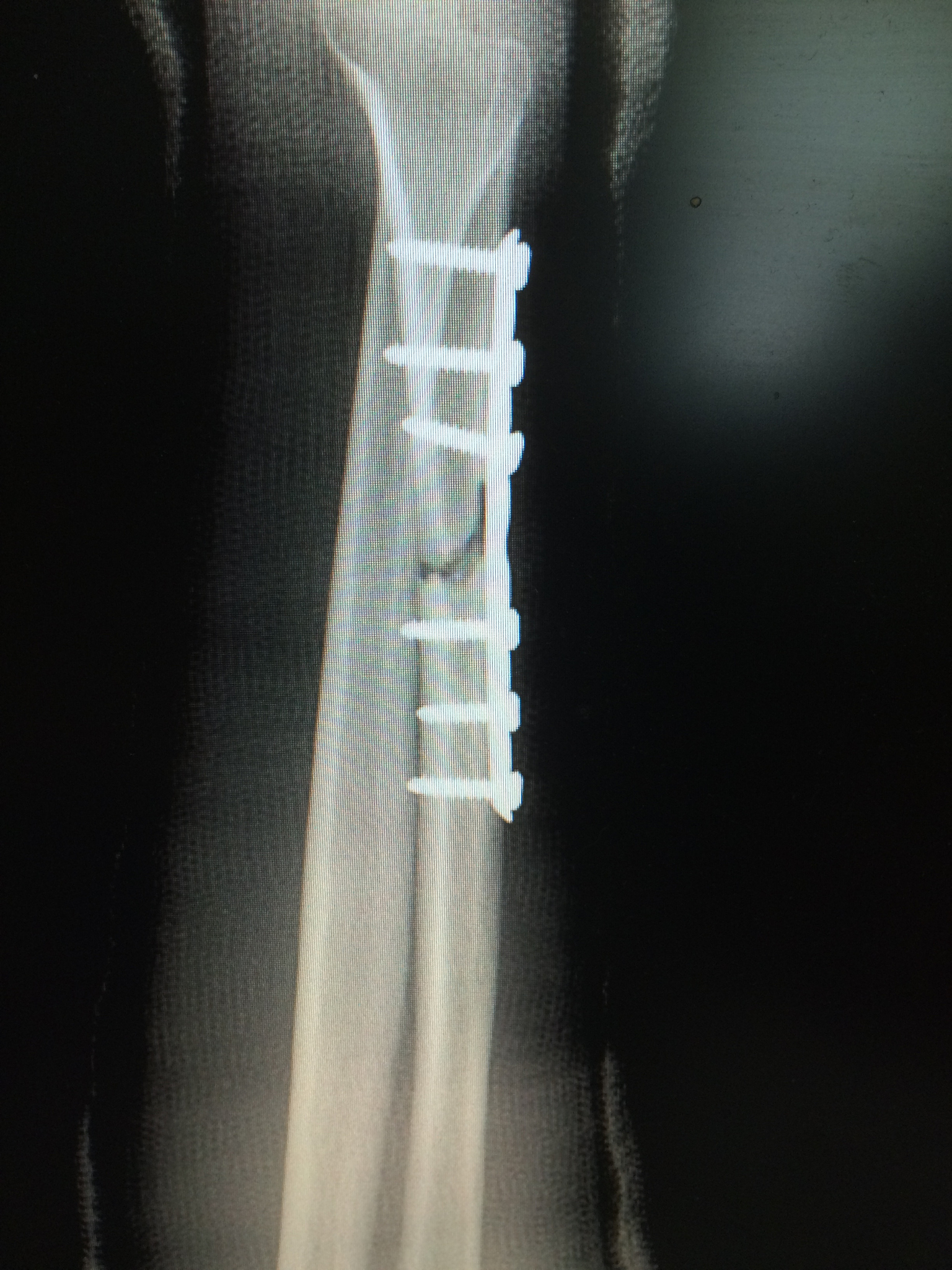 生物材料治疗肩袖损伤选题